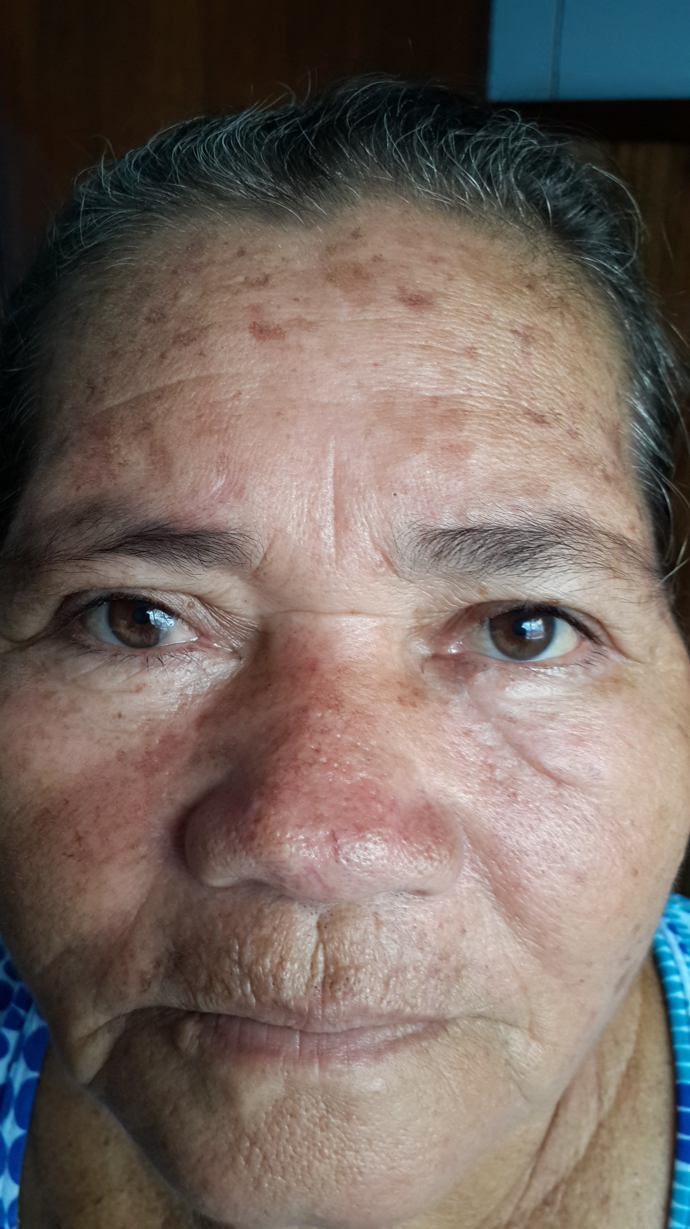 CARCINOMA BASOCELULAR y COLGAJOS