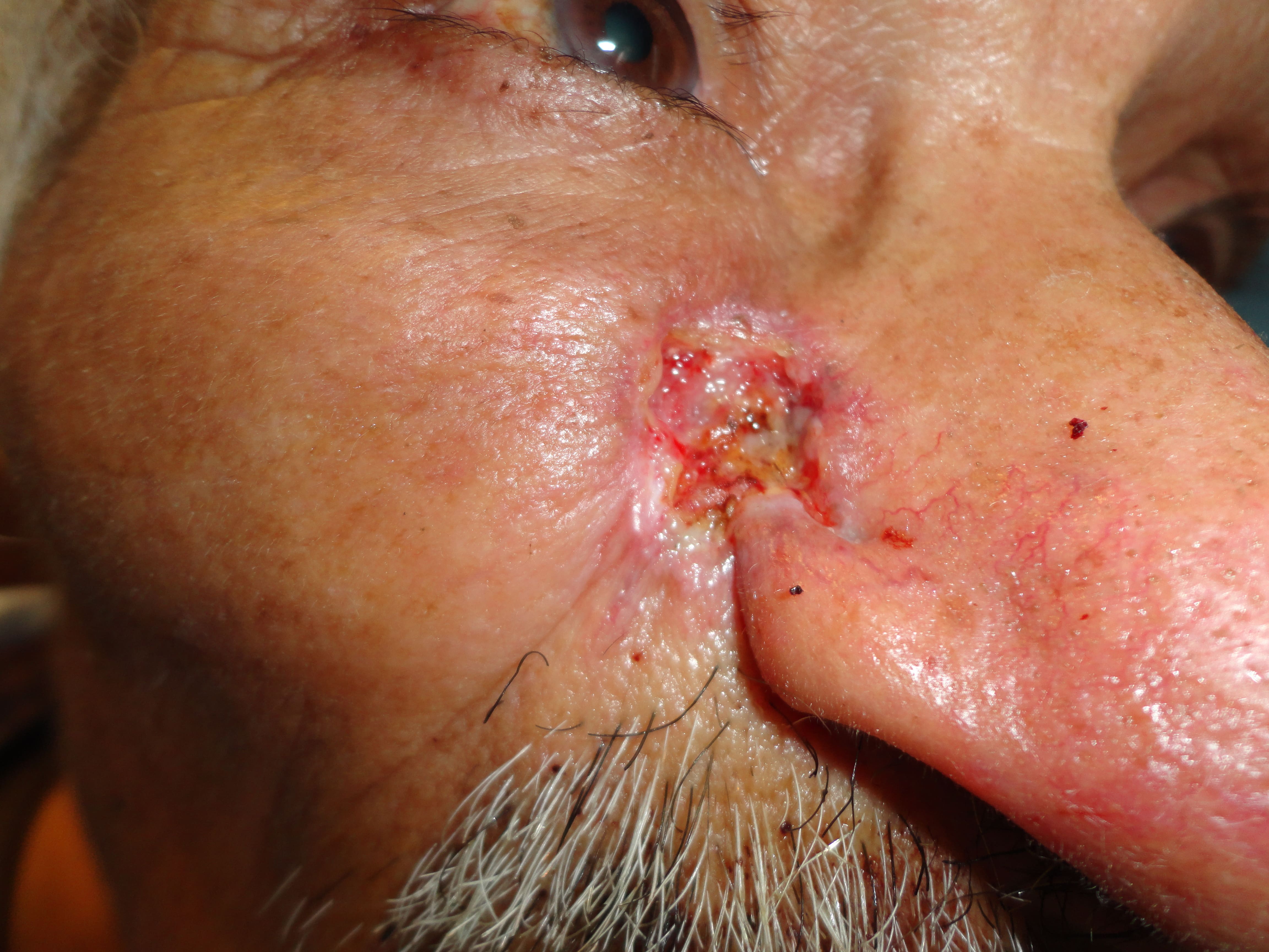 CARCINOMA BASOCELULAR DE LA NARIZ