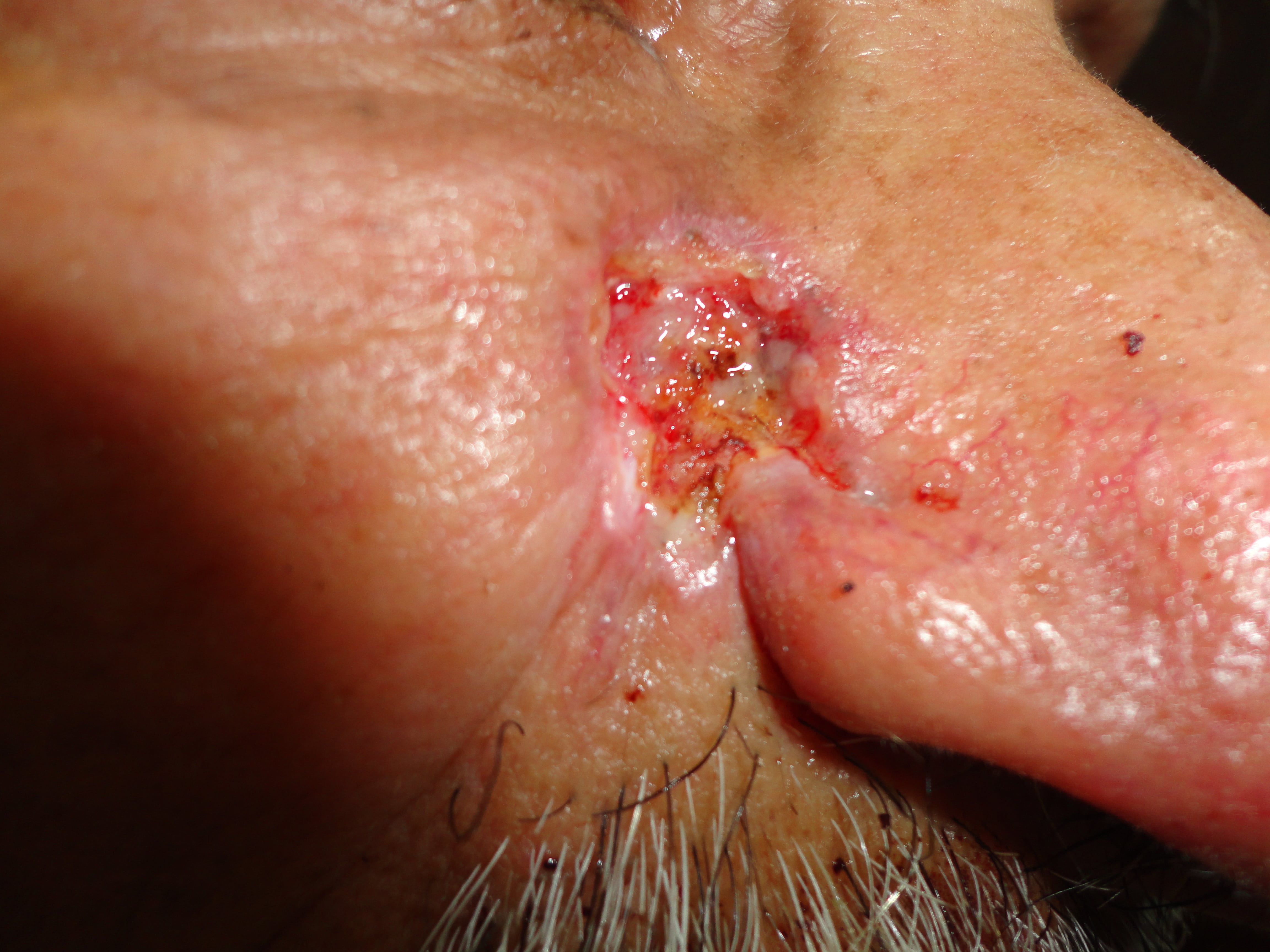 CARCINOMA BASOCELULAR DE LA NARIZ