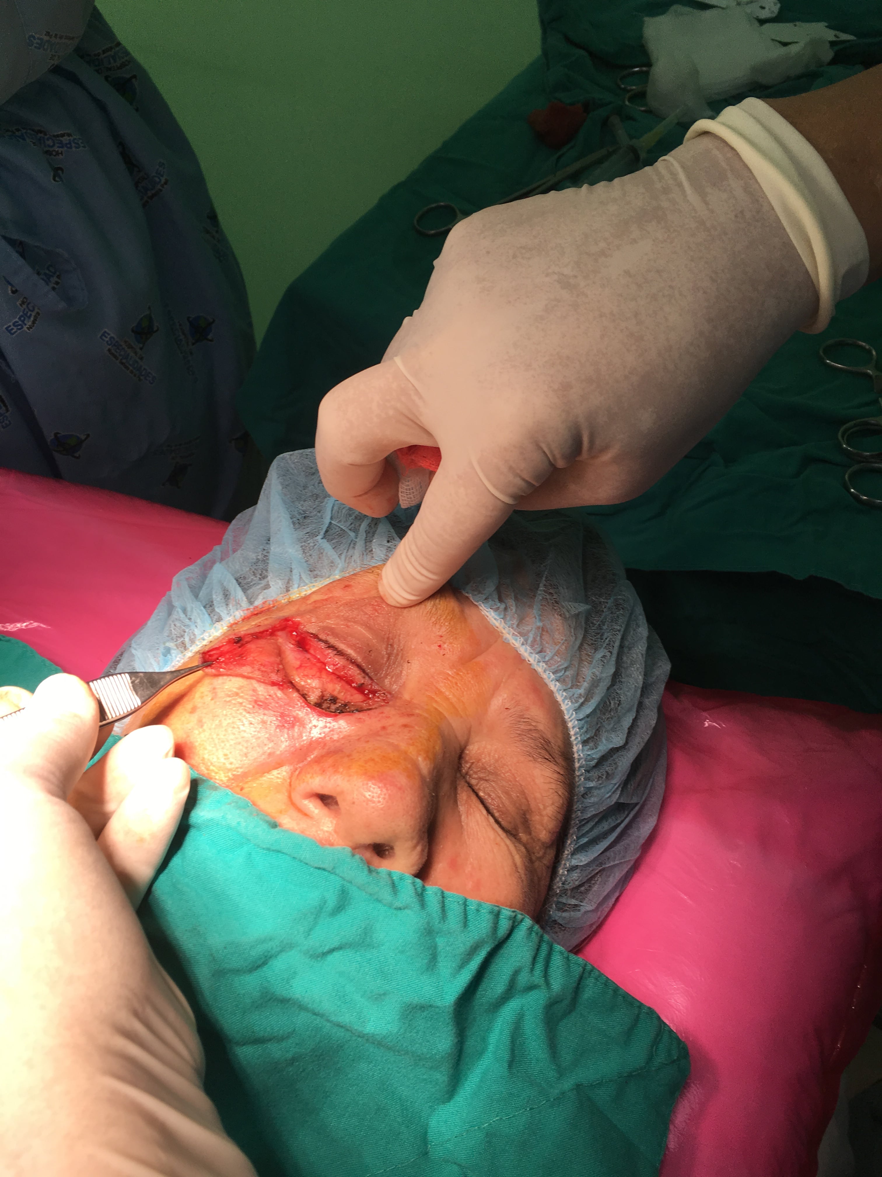 CARCINOMA BASOCELULAR y COLGAJOS