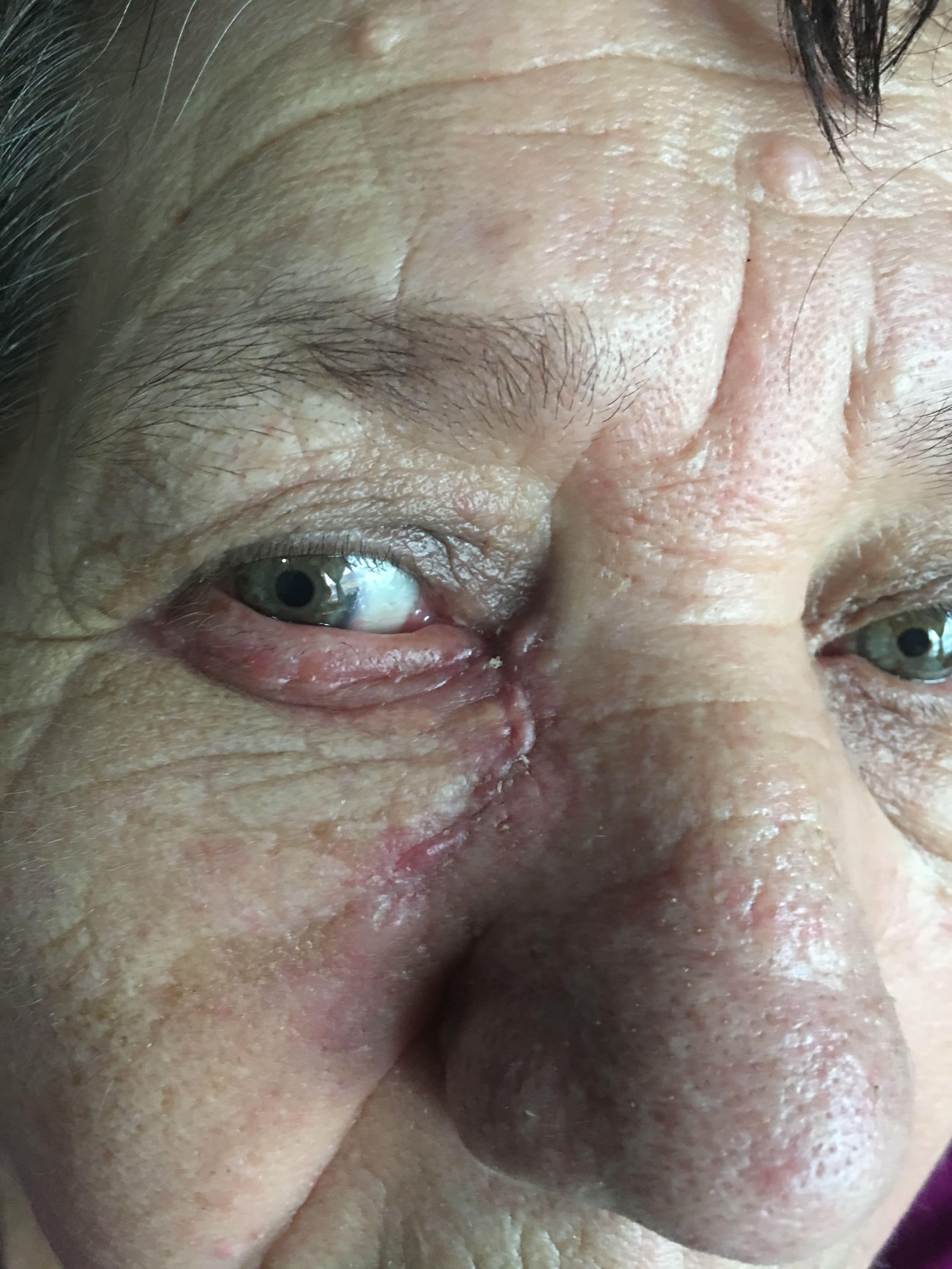 CARCINOMA BASOCELULAR y COLGAJOS