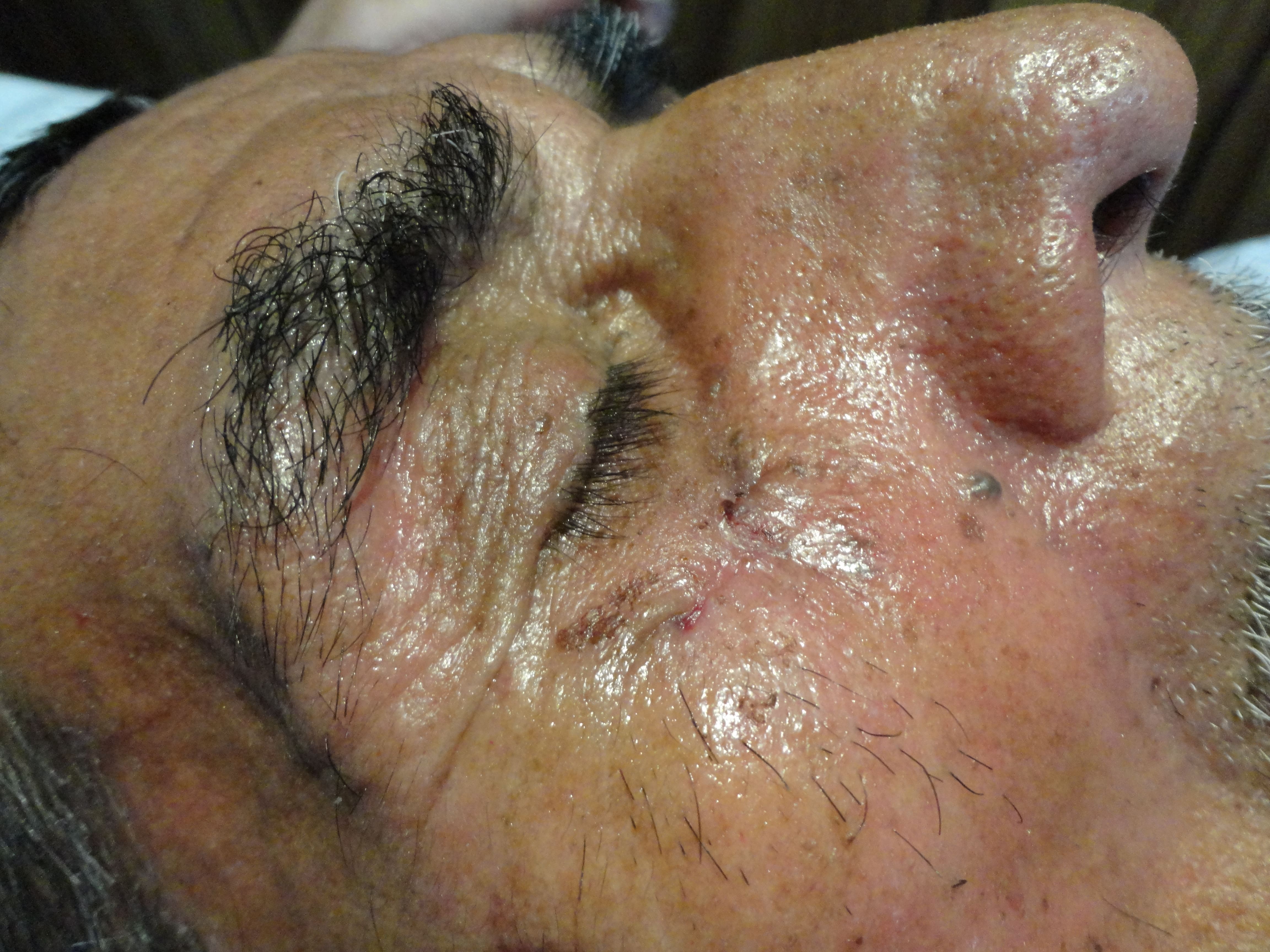 CARCINOMA BASOCELULAR DE CARA - BIOPSIA