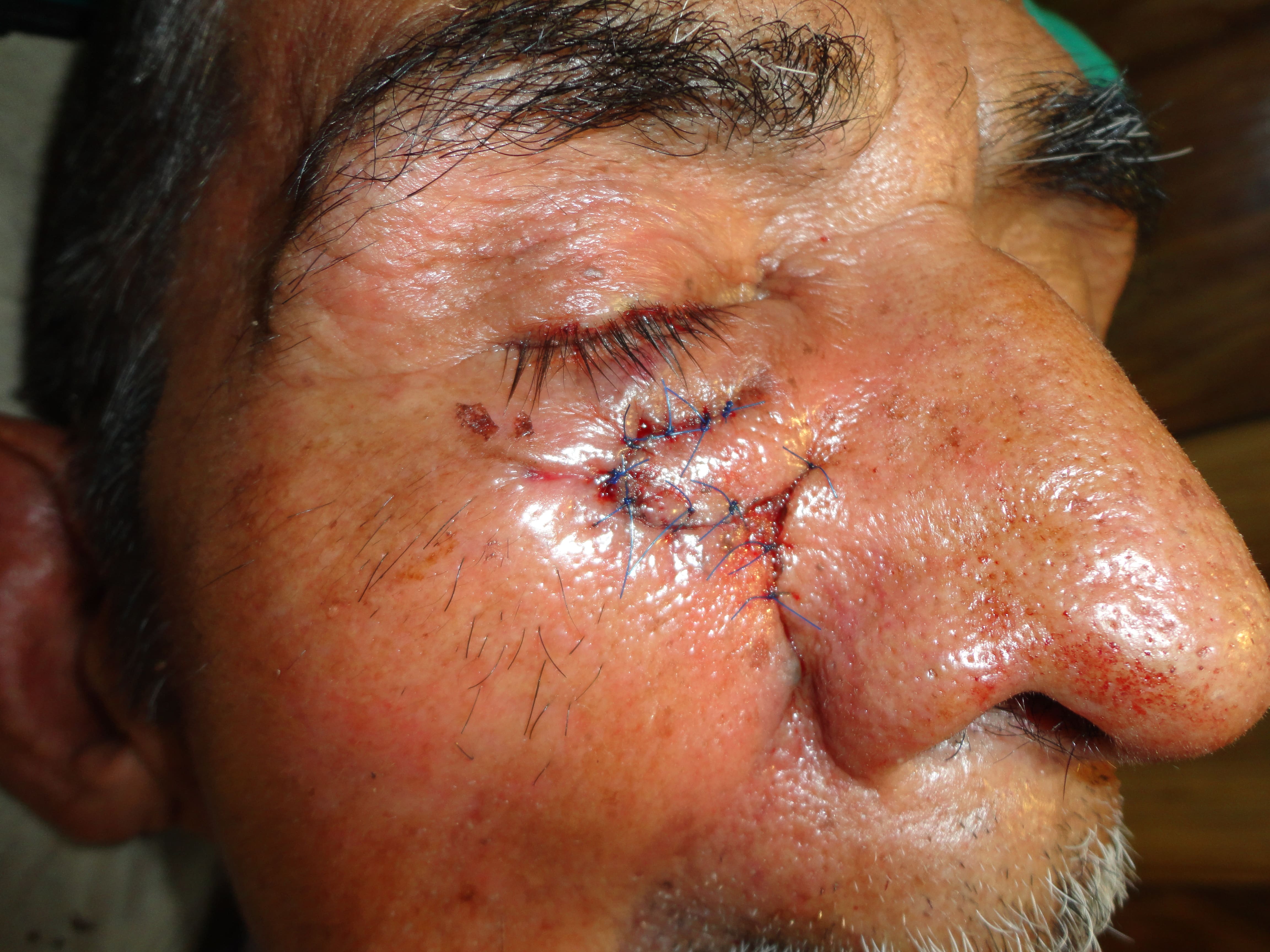 CARCINOMA BASOCELULAR DE CARA - COLGAJO