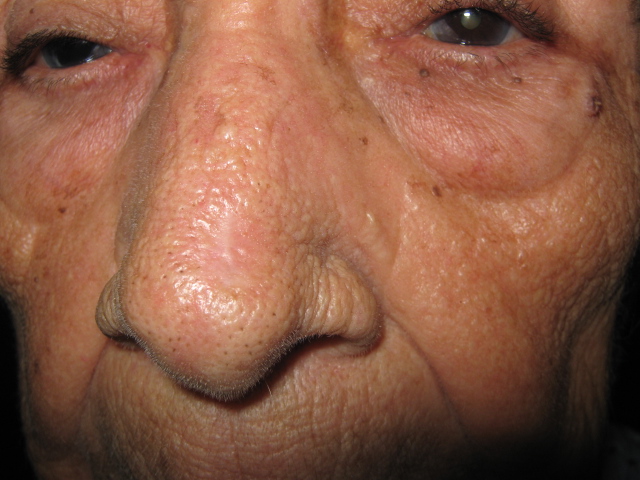 CARCINOMA BASOCELULAR DE NARIZ - CURETAJE + IMIQUIMOD