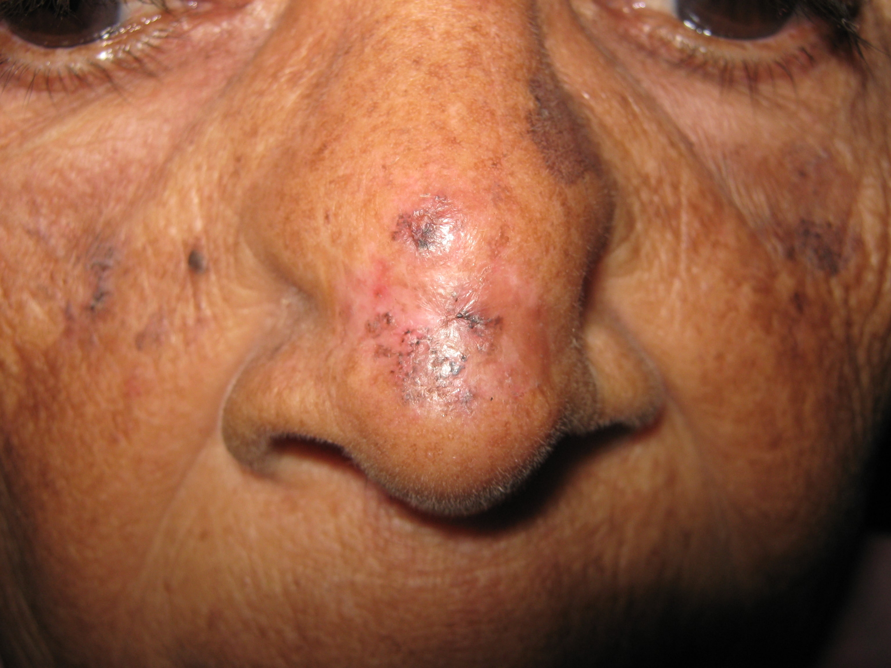 CARCINOMA BASOCELULAR DE NARIZ - CURETAJE + IMIQUIMOD