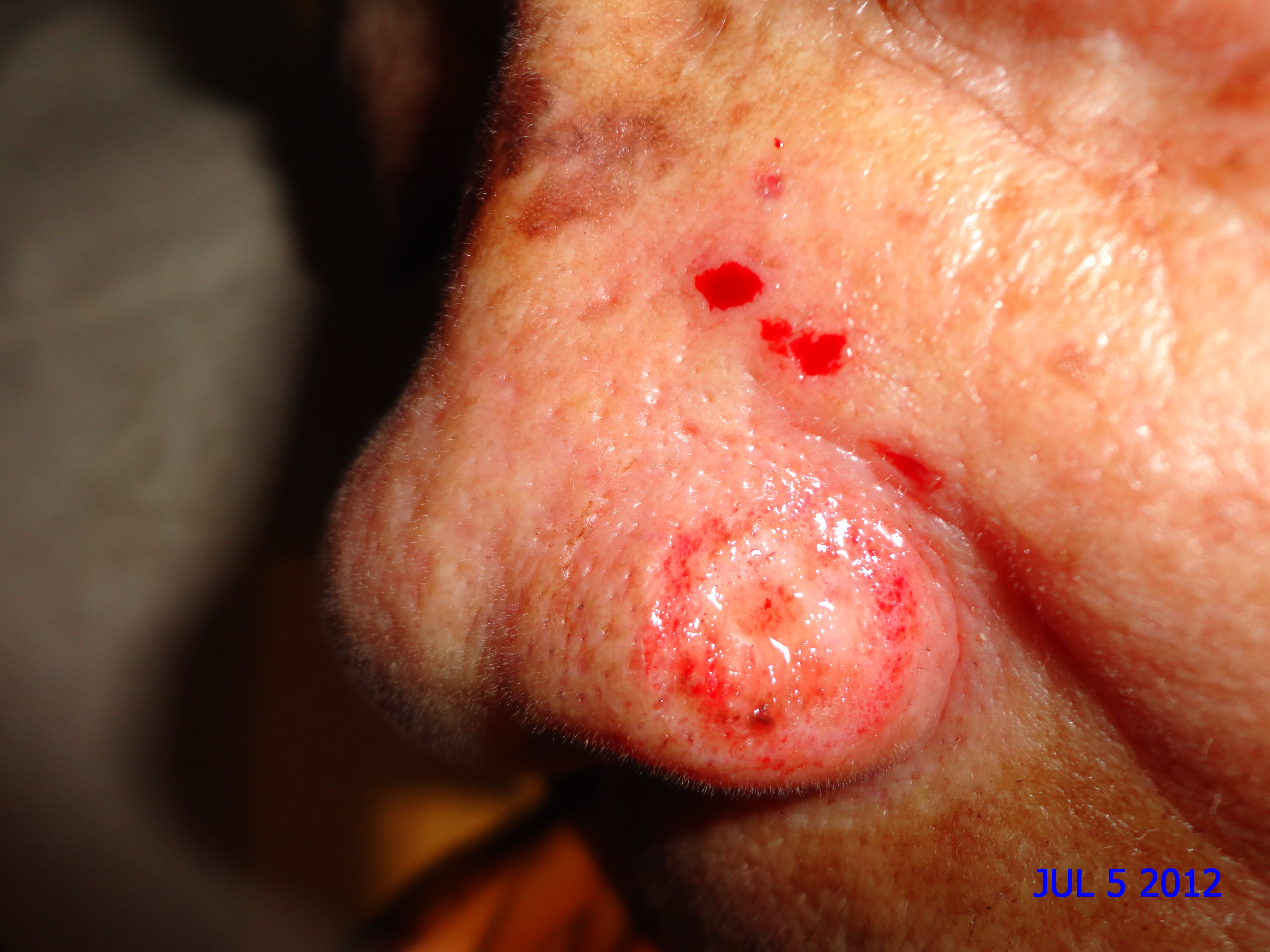 CARCINOMA BASOCELULAR DE NARIZ + CURETAJE + IMIQUIMOD