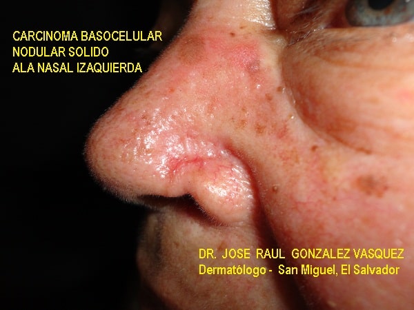 CARCINOMA BASOCELULAR ALA NASAL-CURETAJE +IMIQUIMOD