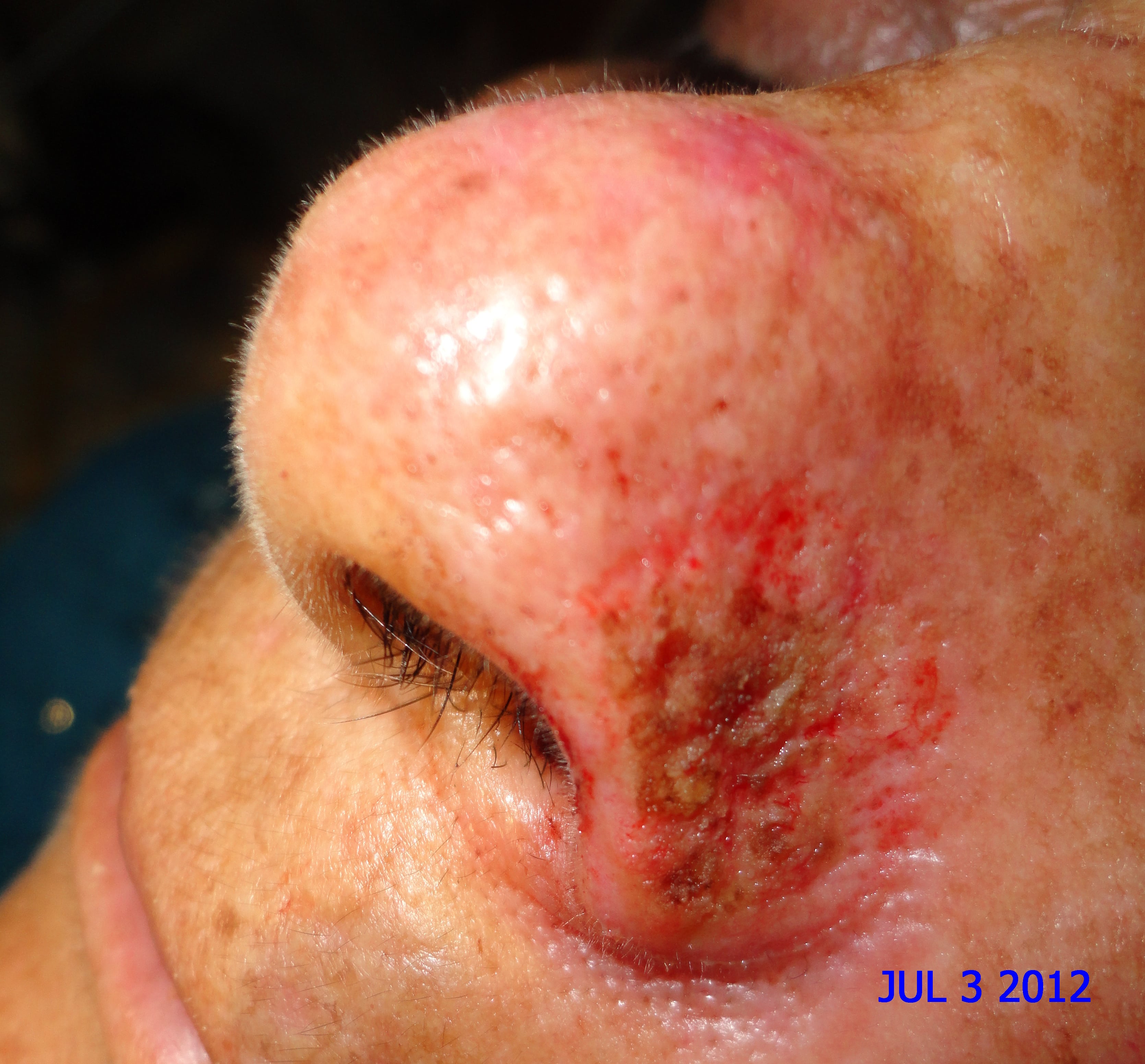 CARCINOMA BASOCELULAR ALA NASAL-CURETAJE +IMIQUIMOD