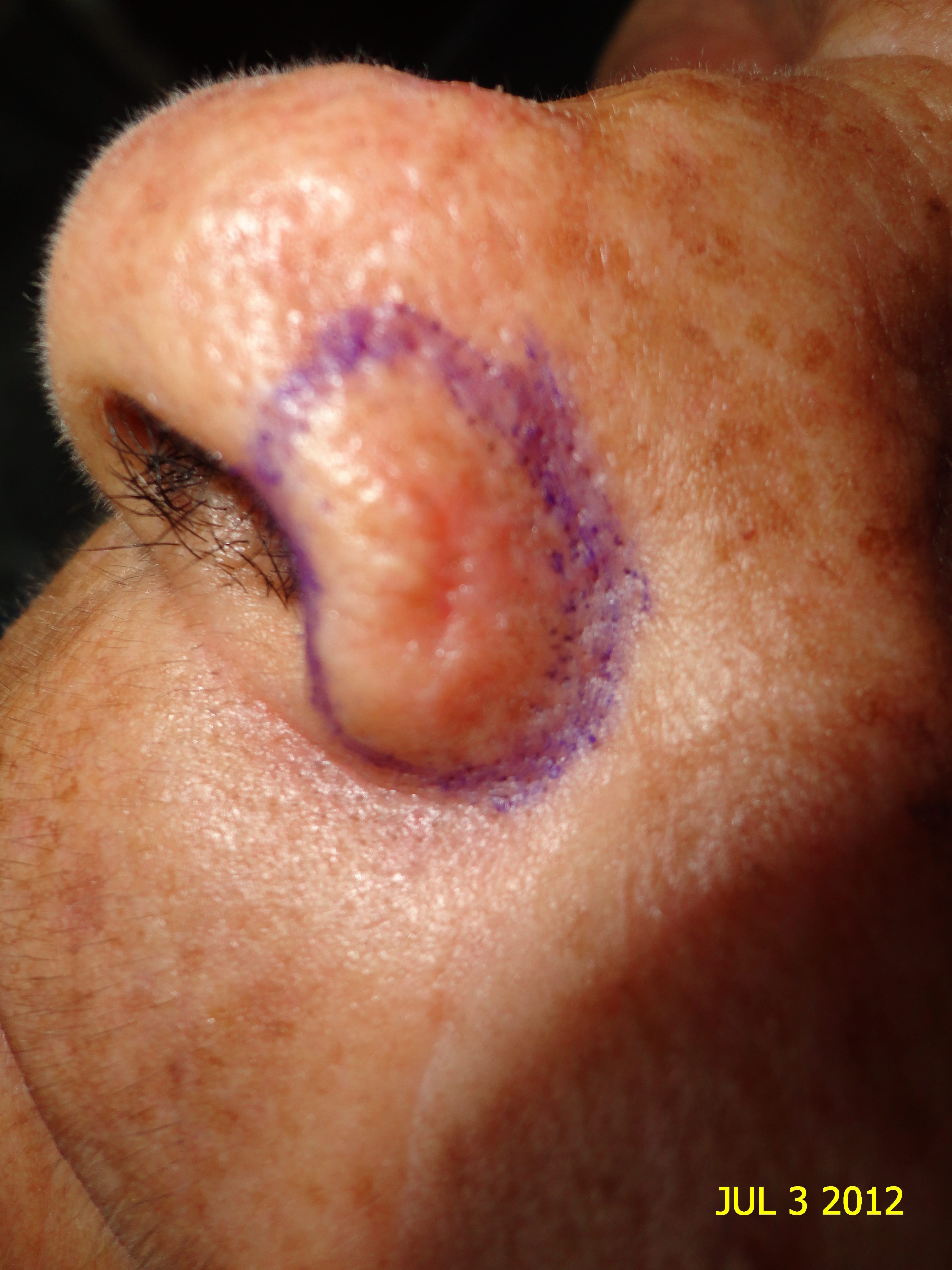 CARCINOMA BASOCELULAR ALA NASAL-CURETAJE +IMIQUIMOD