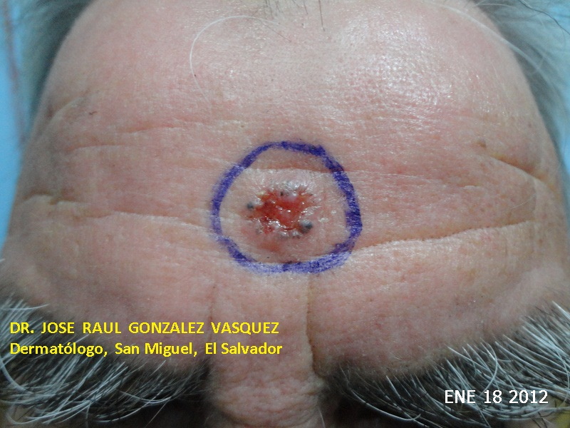 CARCINOMA BASOCELULAR DE LA FRENTE - CURETAJE + IMIQUIMOD