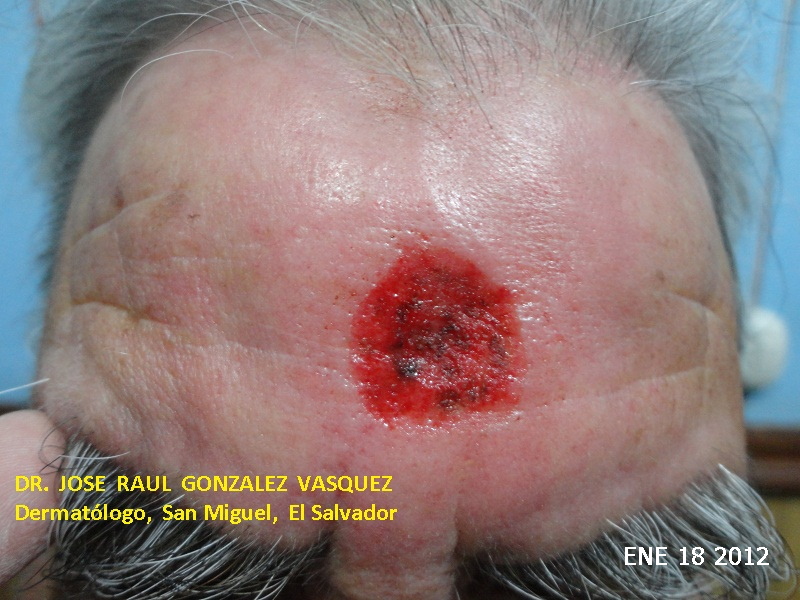 CARCINOMA BASOCELULAR DE LA FRENTE - CURETAJE + IMIQUIMOD