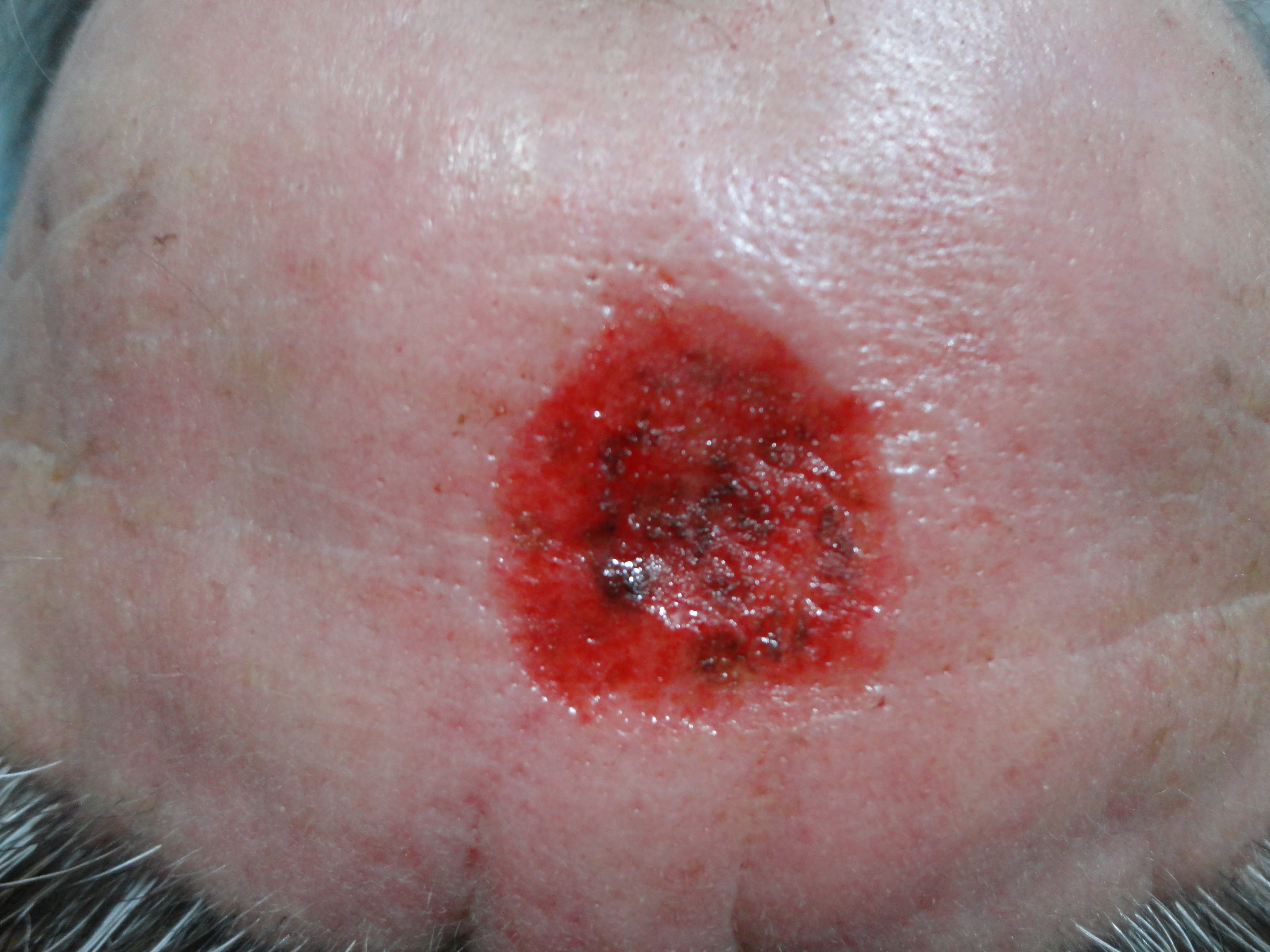 CARCINOMA BASOCELULAR DE LA FRENTE - CURETAJE + IMIQUIMOD