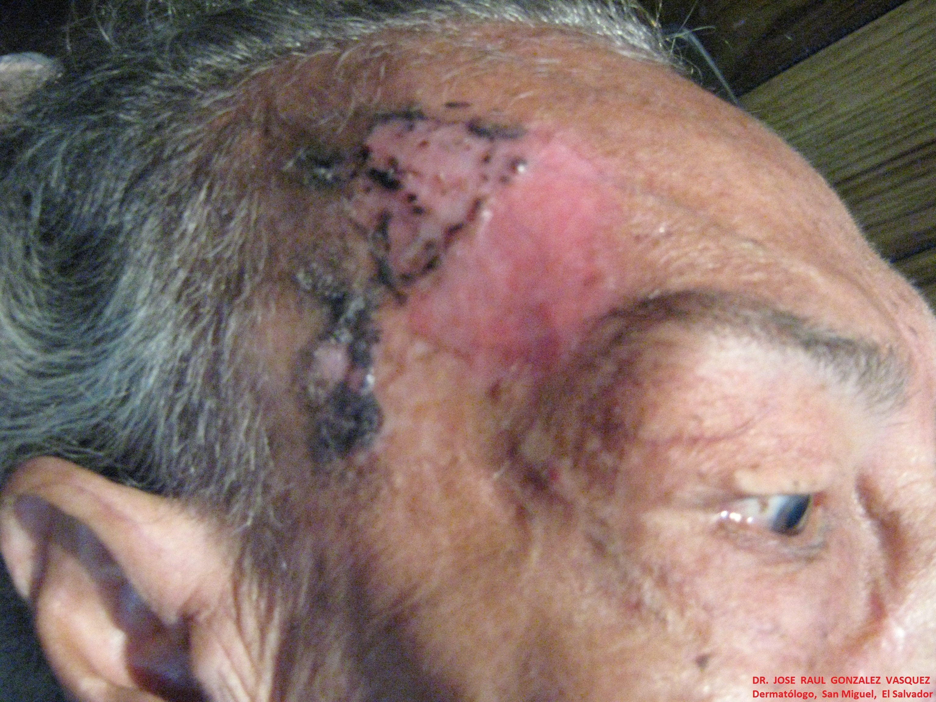 CARCINOMA BASOCELULAR - CURETAJE + IMIQUIMOD