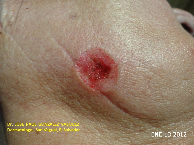 CARCINOMA BASOCELULAR - CURETAJE