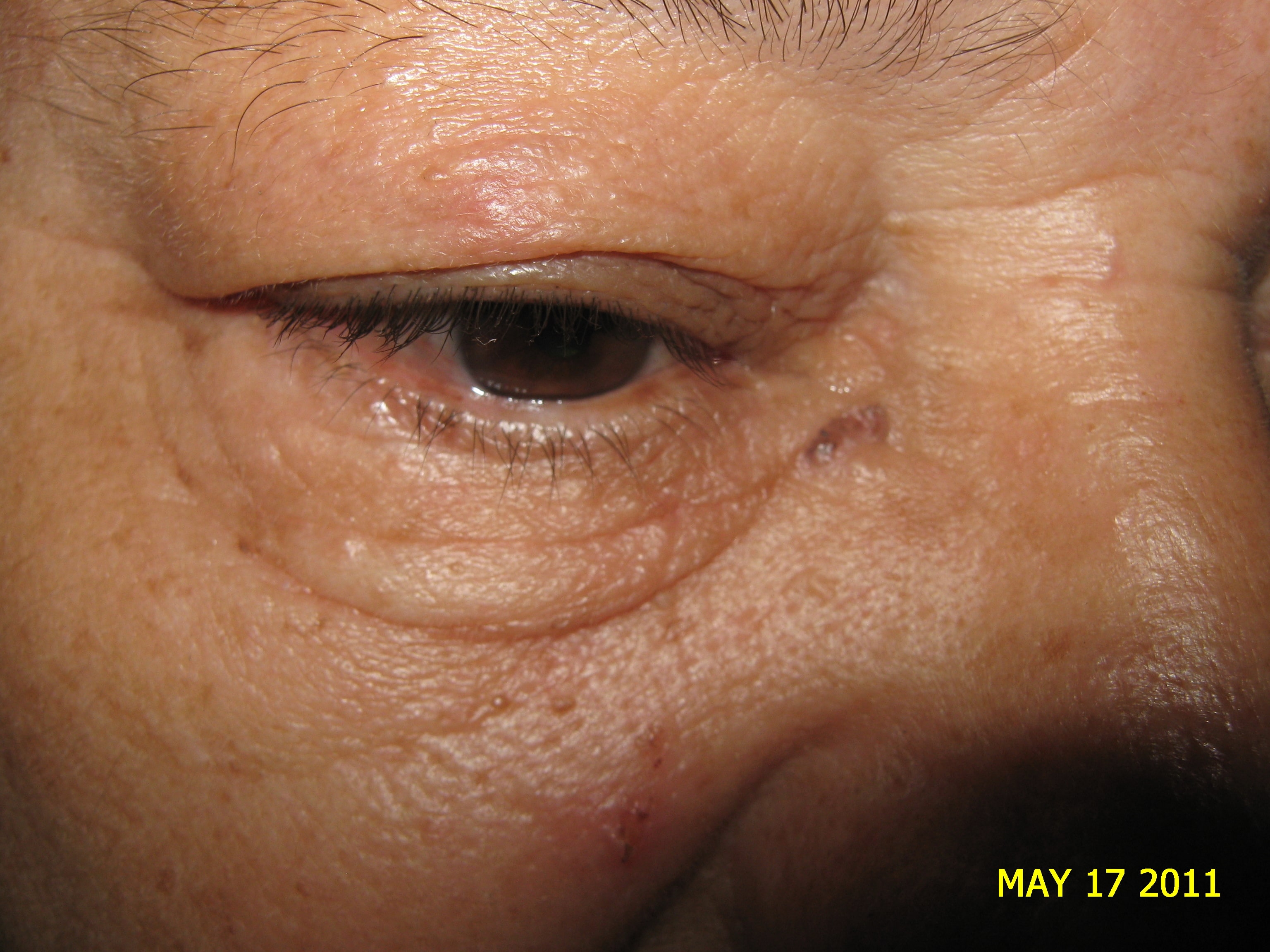 CARCINOMA BASOCELULAR CANTO INTERNO OJO DERECHO