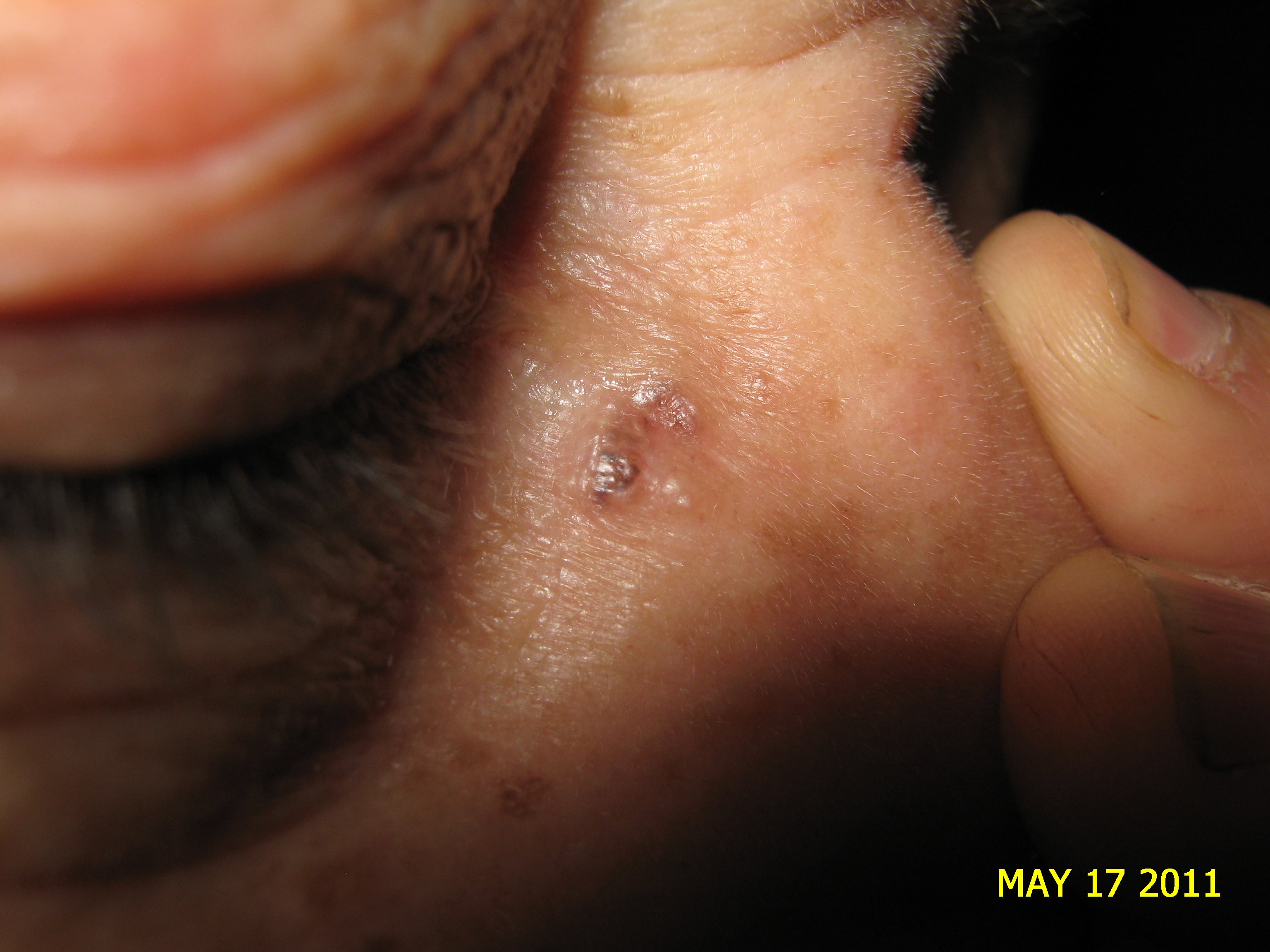 CARCINOMA BASOCELULAR CANTO INTERNO OJO DERECHO