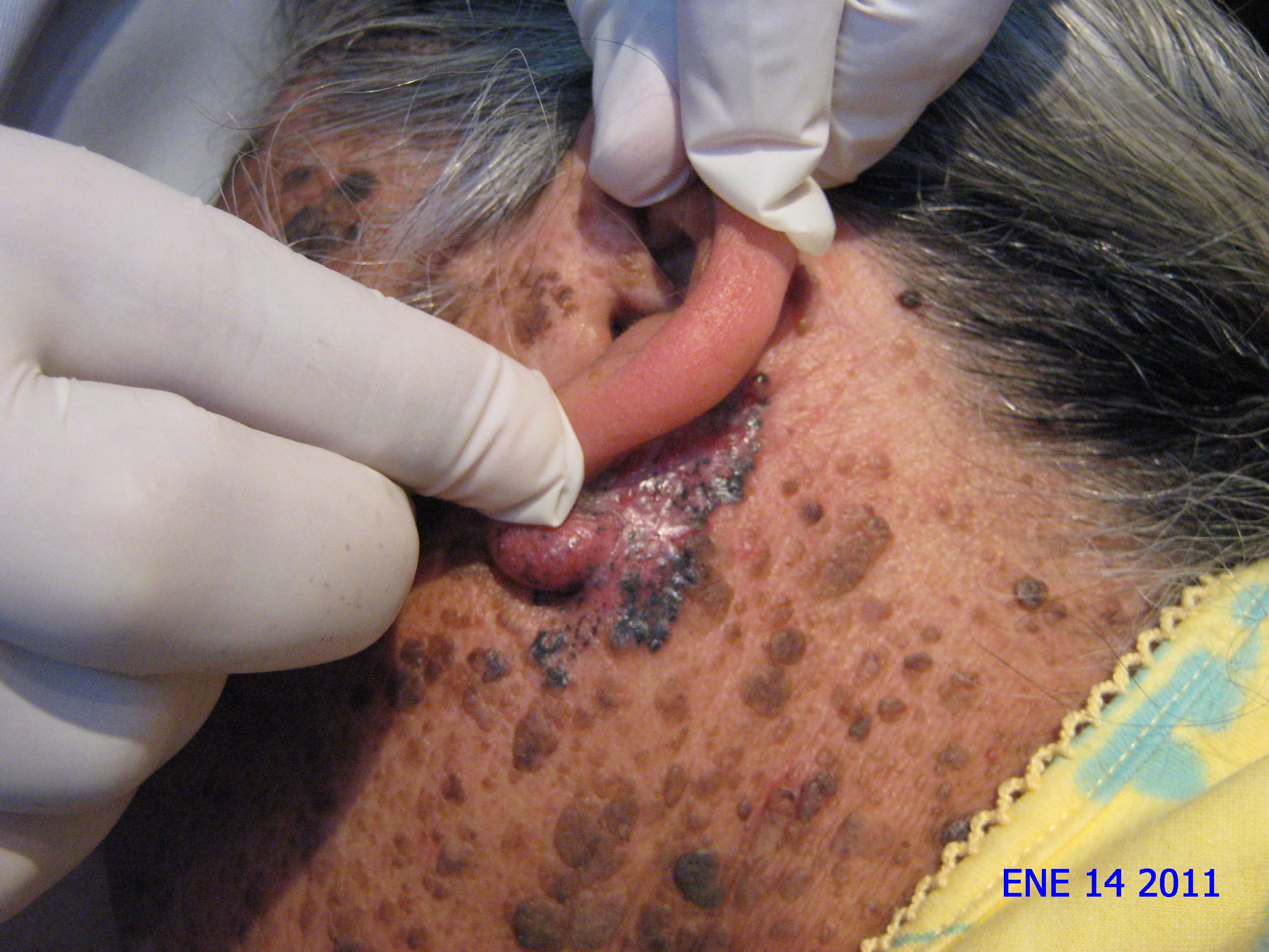 CARCINOMA BASOCELULAR RETRO Y PREAURICULAR