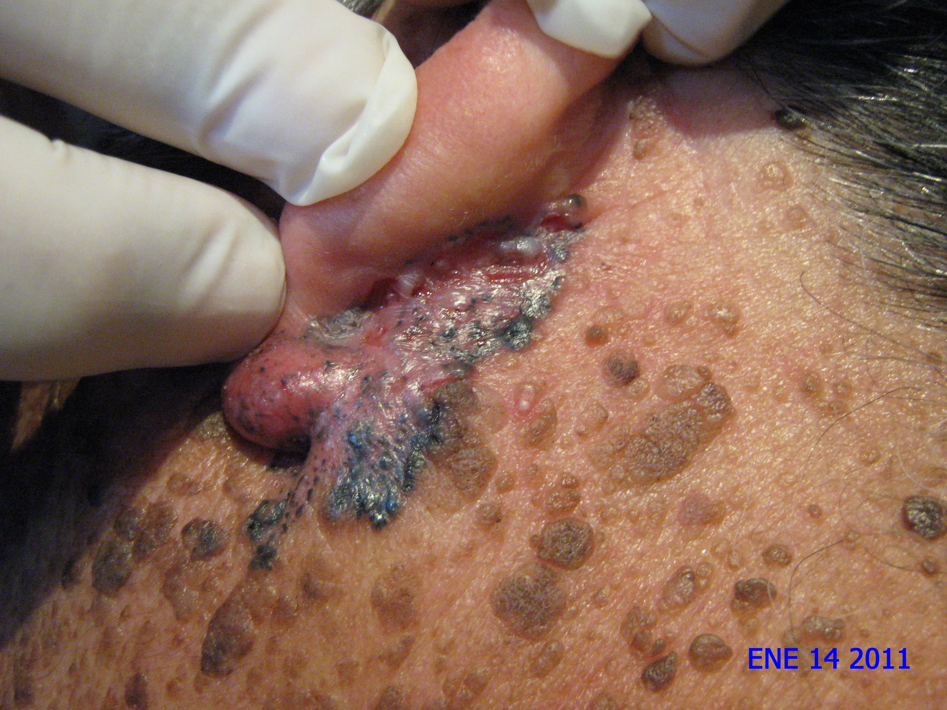 CARCINOMA BASOCELULAR RETRO Y PREAURICULAR