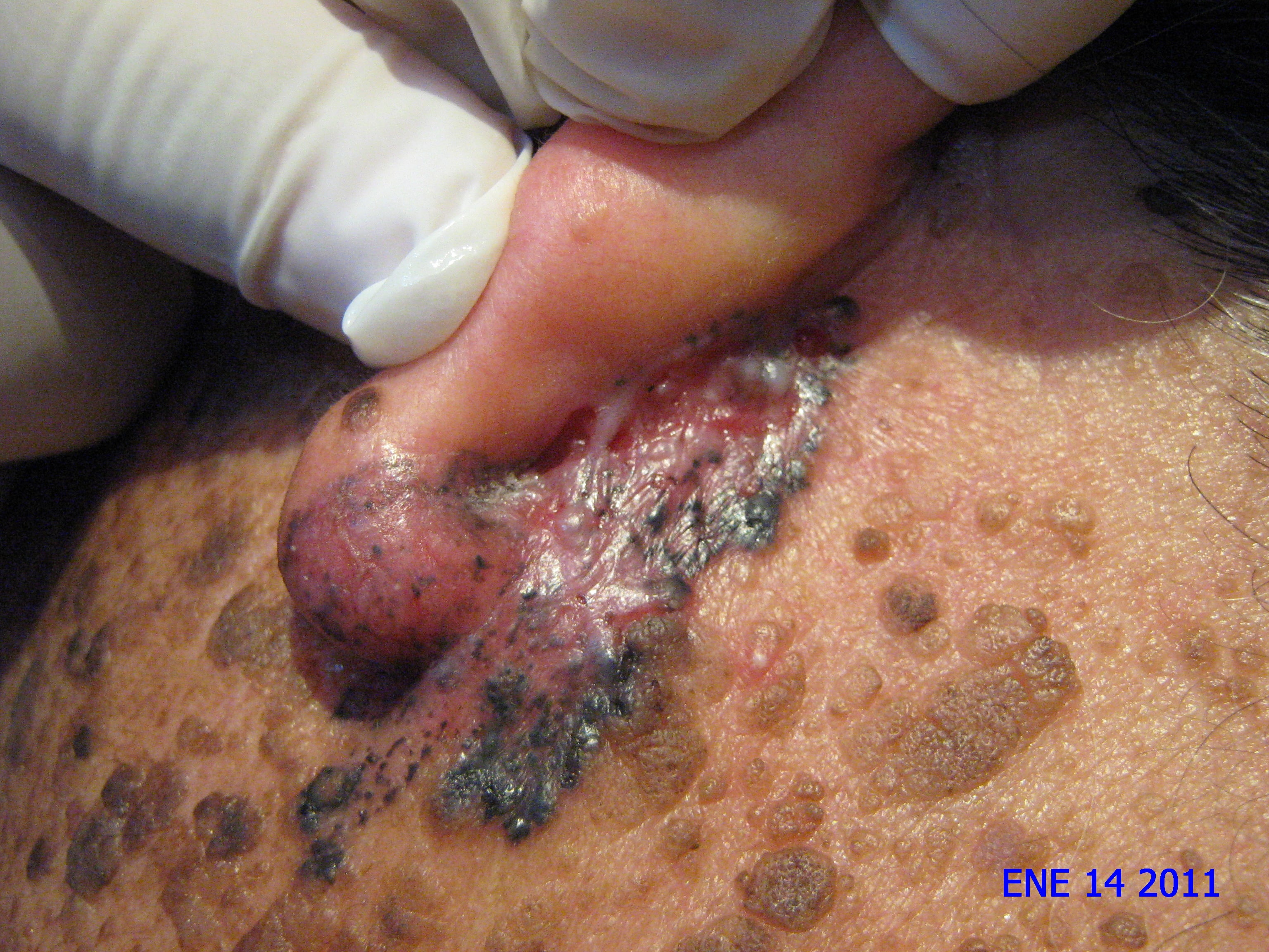 CARCINOMA BASOCELULAR RETRO Y PREAURICULAR