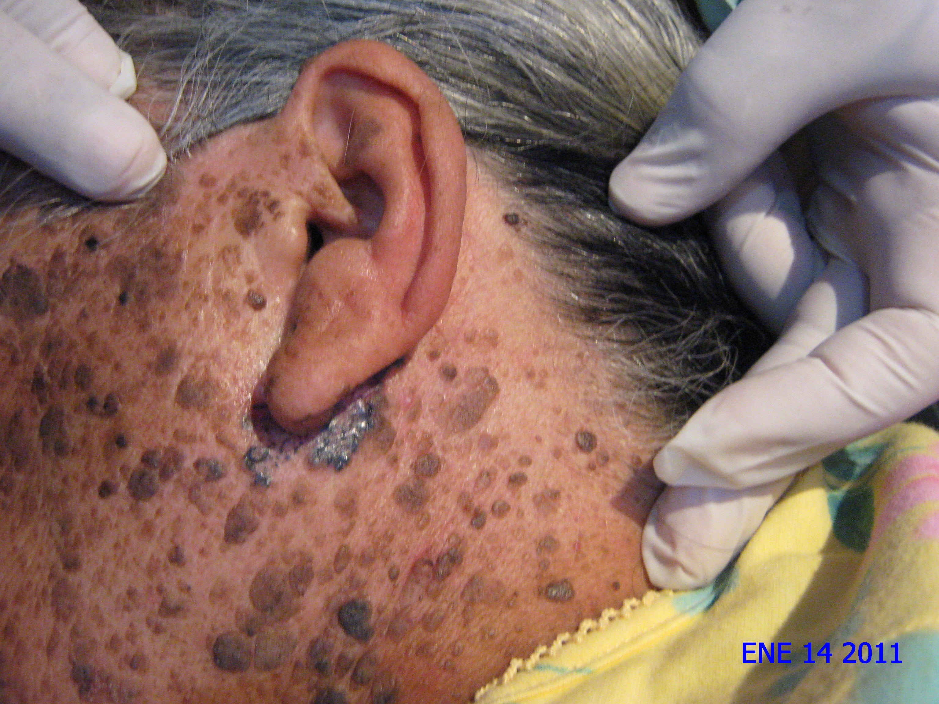 CARCINOMA BASOCELULAR RETRO Y PREAURICULAR