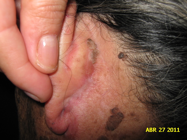 CARCINOMA BASOCELULAR - CURETAJE + IMIQUIMOD