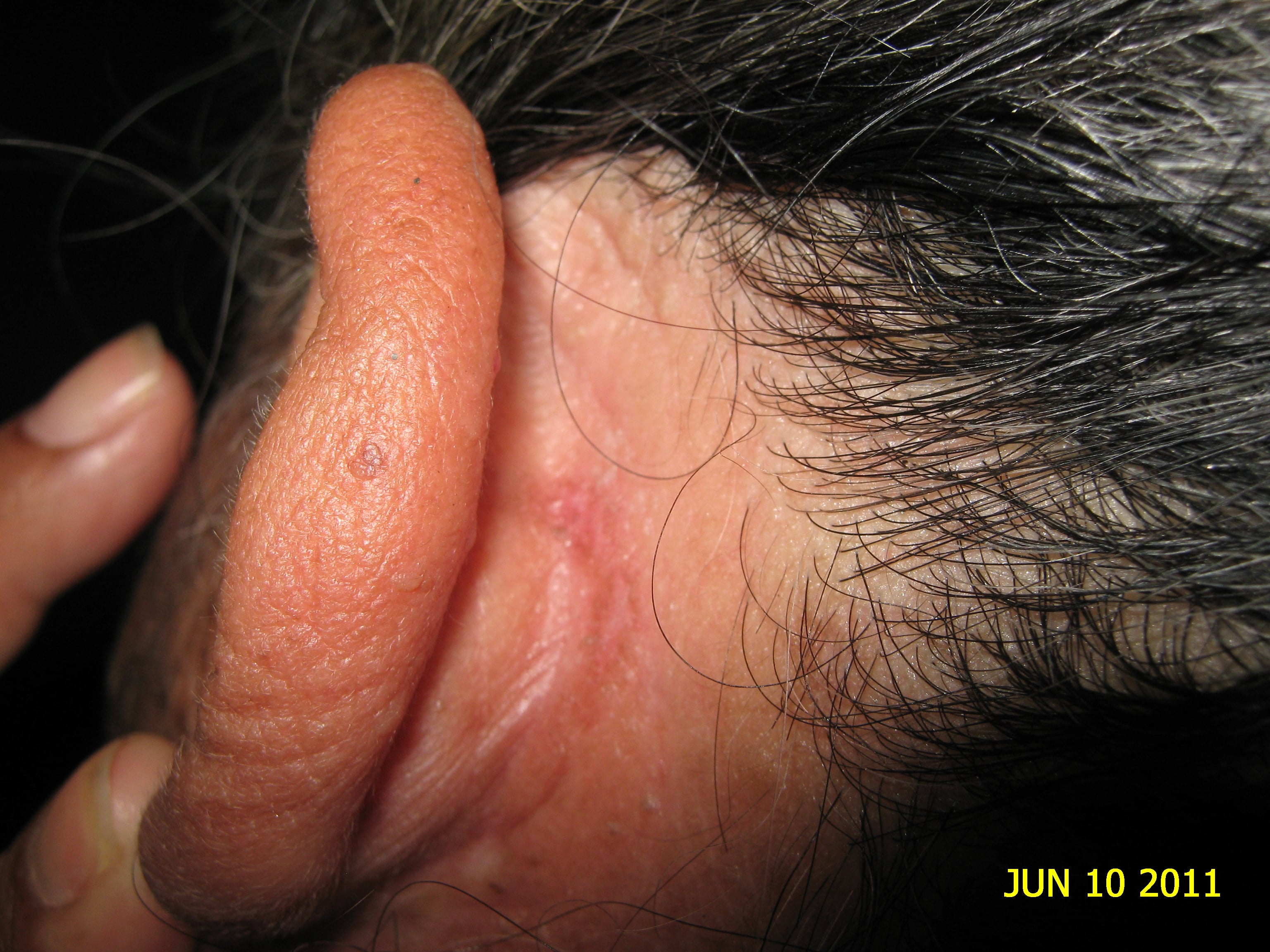 CARCINOMA BASOCELULAR - CURETAJE + IMIQUIMOD