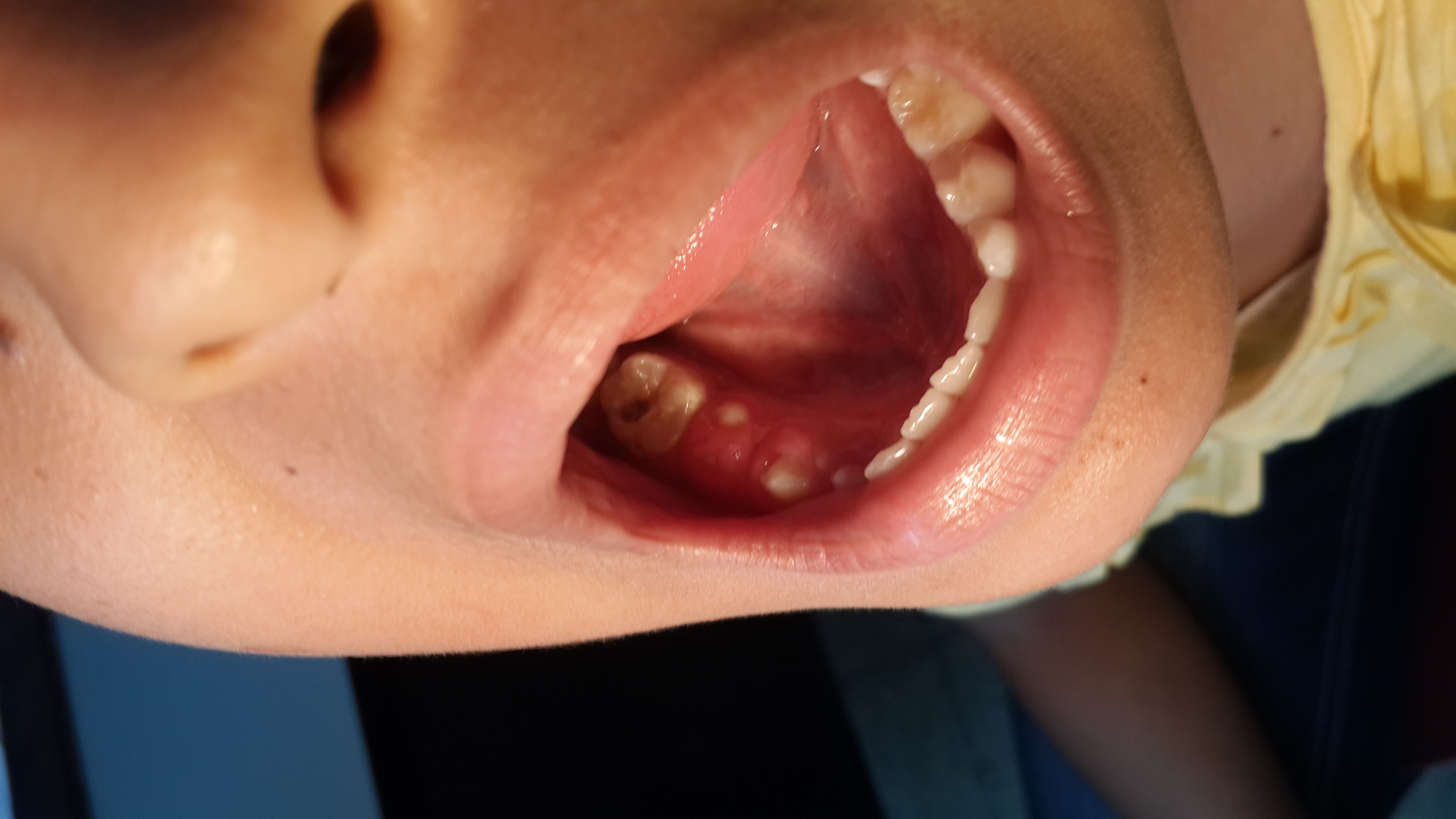 FISTULA CUTANEA PERIODONTOGENICA