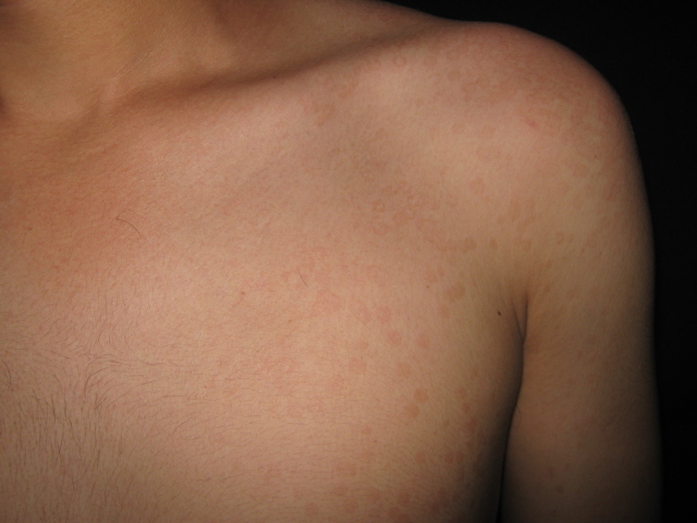 PITIRIASIS VERSICOLOR