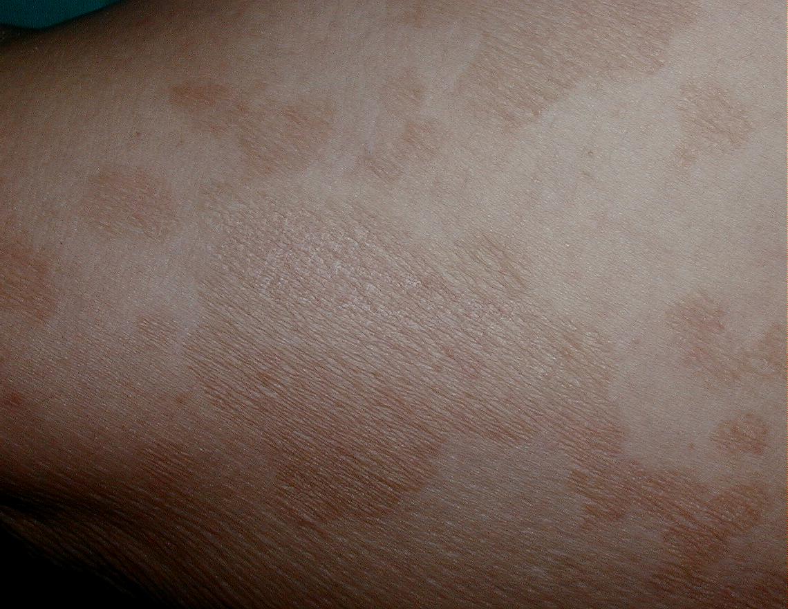 PITIRIASIS VERSICOLOR