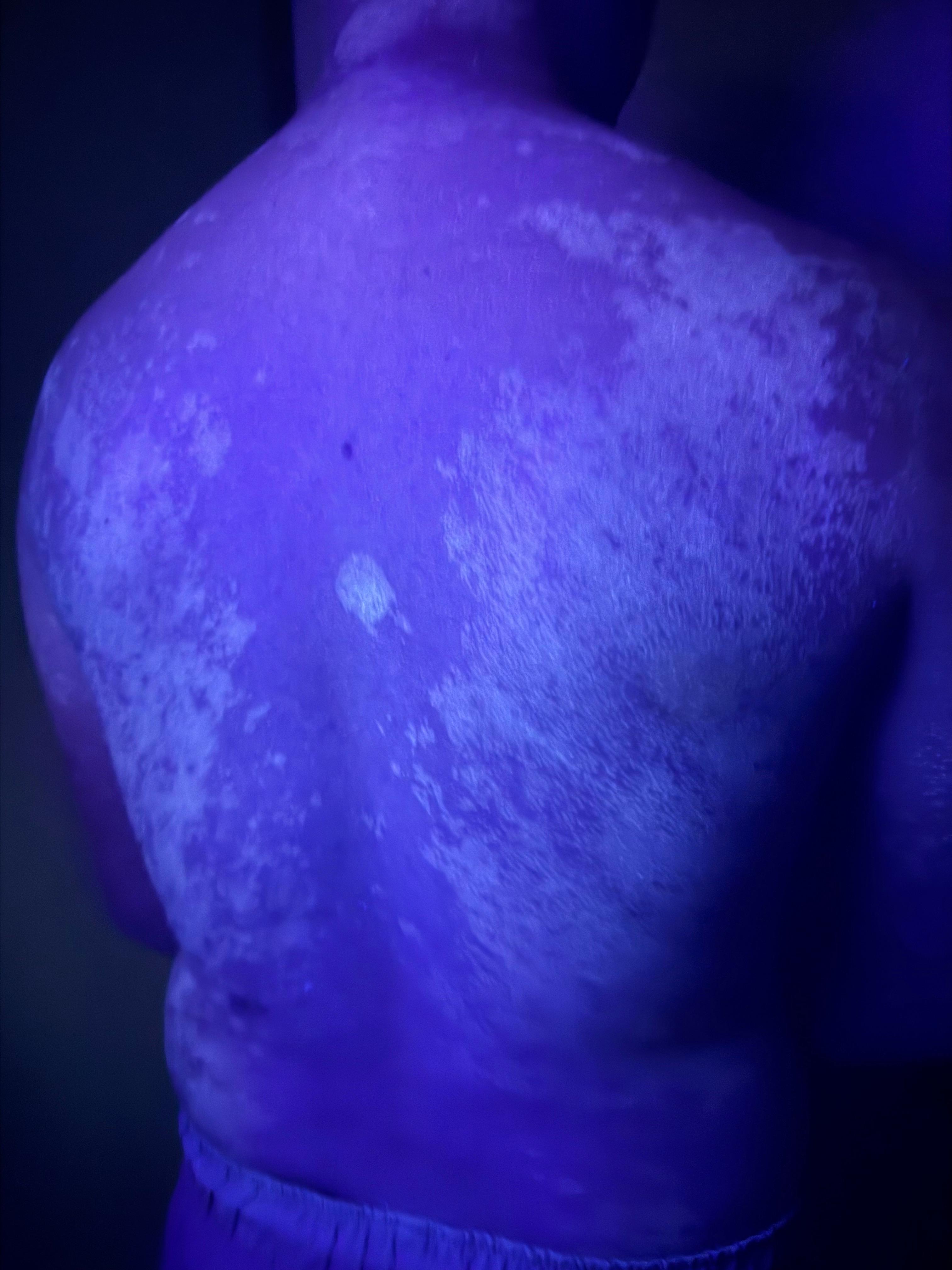 PITIRIASIS VERSICOLOR - LUZ DE WOOD