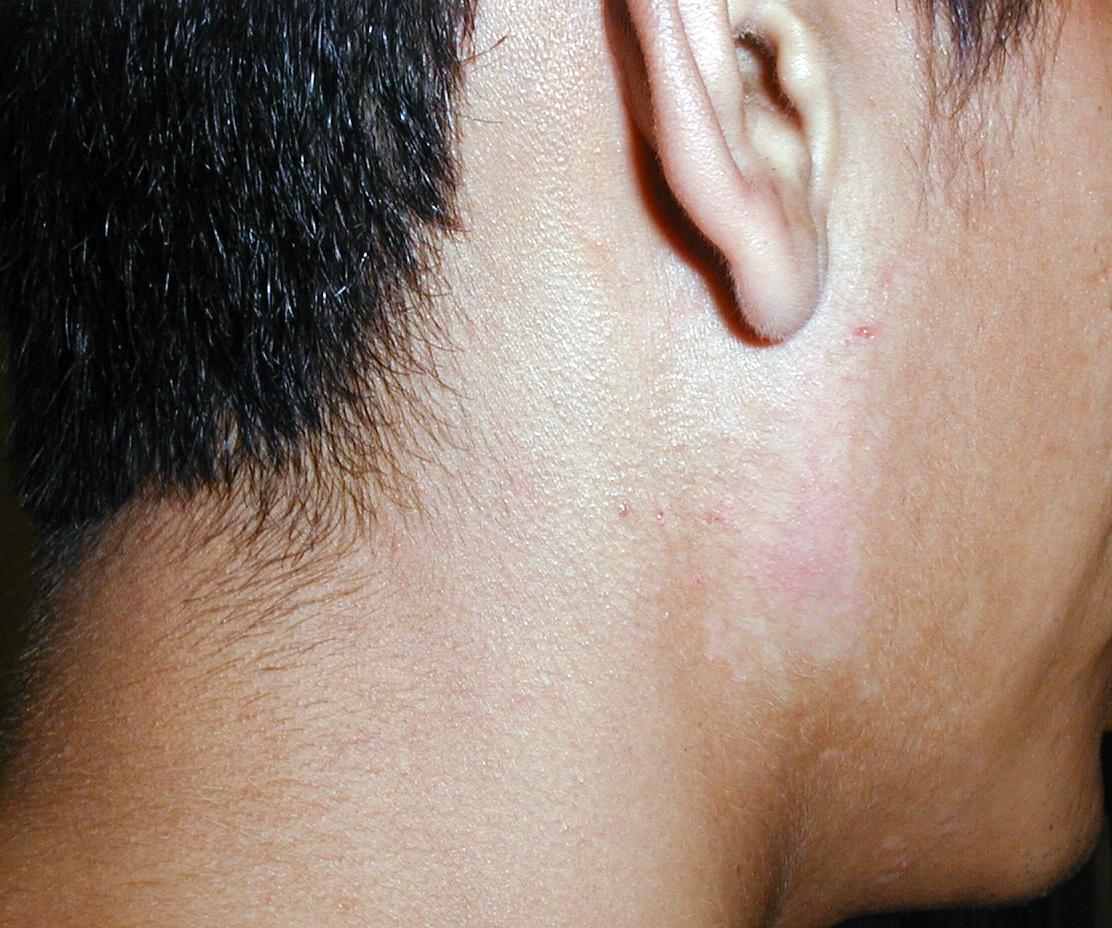 PITIRIASIS VERSICOLOR