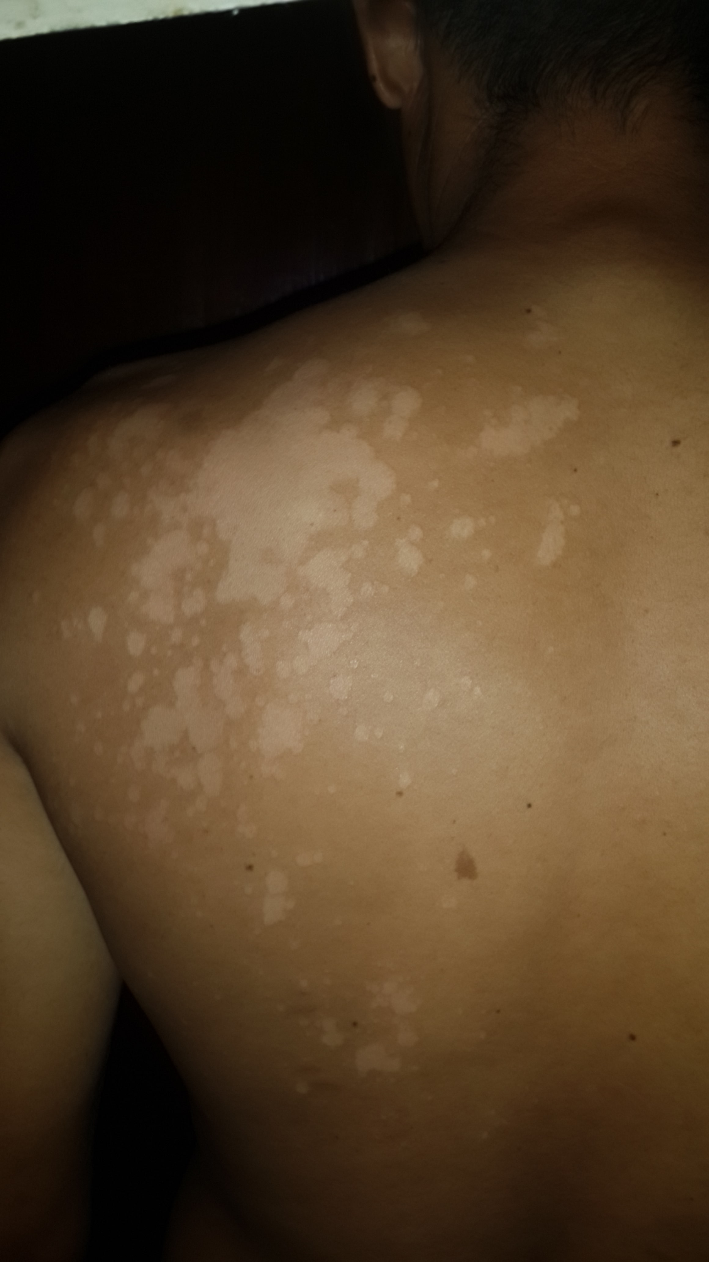 PITIRIASIS VERSICOLOR