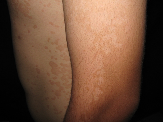 PITIRIASIS VERSICOLOR
