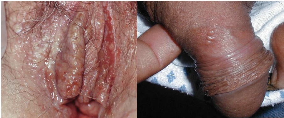 HERPES SIMPLE  GENITAL RECIDIVANTE