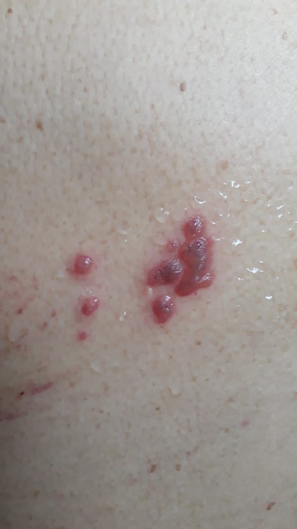 HERPES SIMPLE RECIDIVANTE HEMORRAGICO