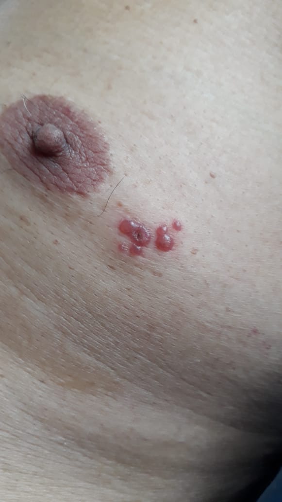 HERPES SIMPLE RECIDIVANTE HEMORRAGICO