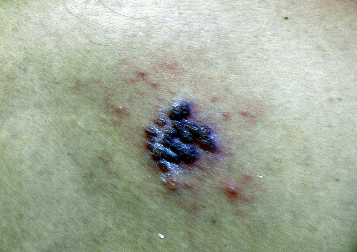 HERPES SIMPLE RECIDIVANTE HEMORRAGICO