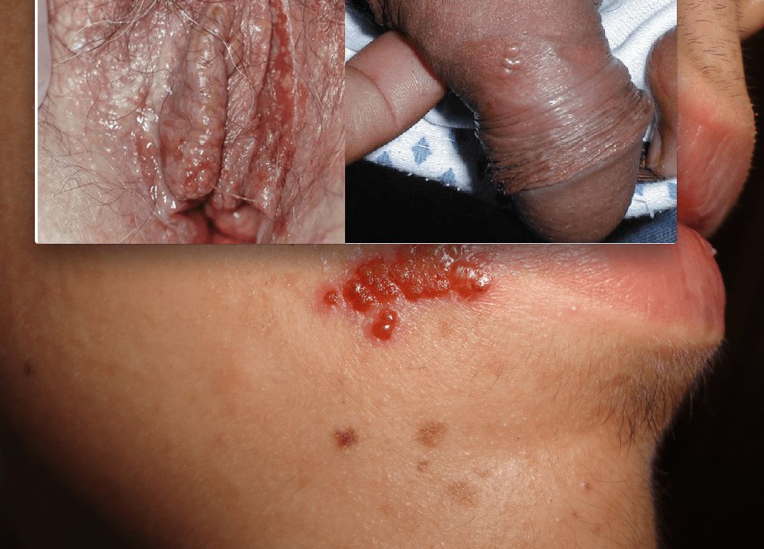 HERPES SIMPLE - TOPOGRAFIA TÍPICA
