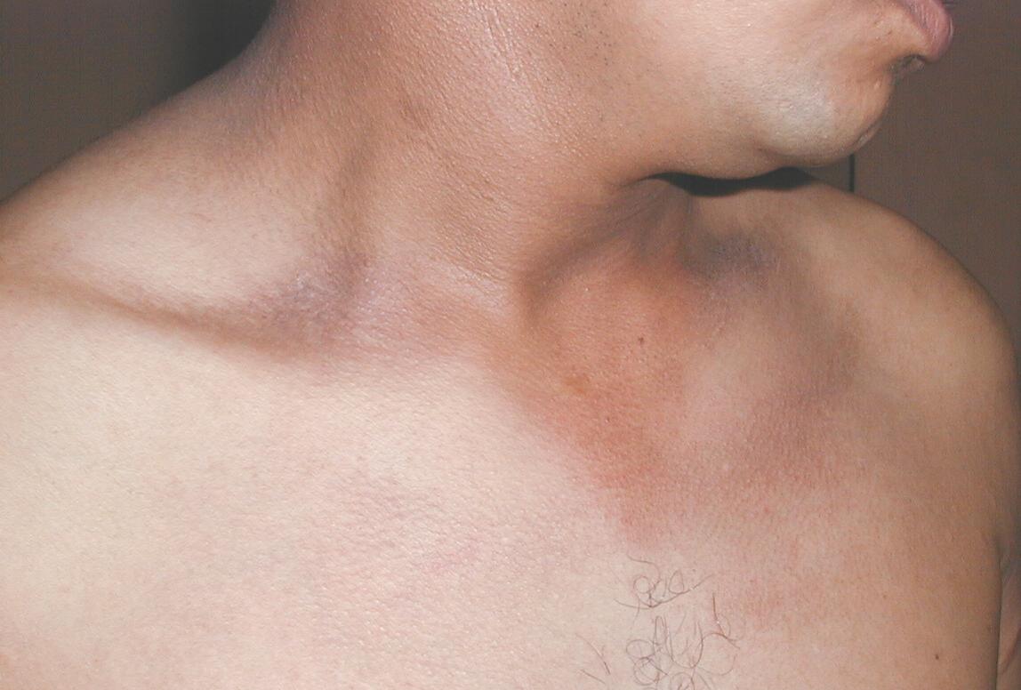 DEERMATOSIS CENICIENTA