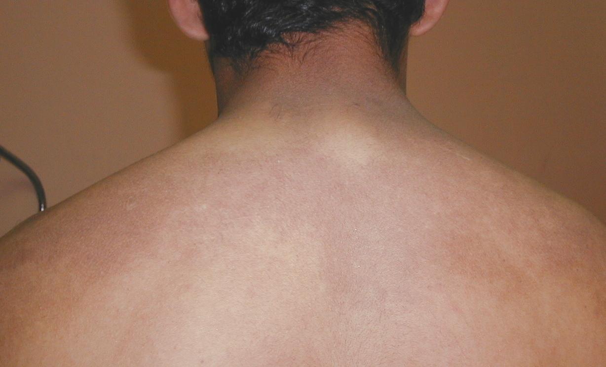 DEERMATOSIS CENICIENTA