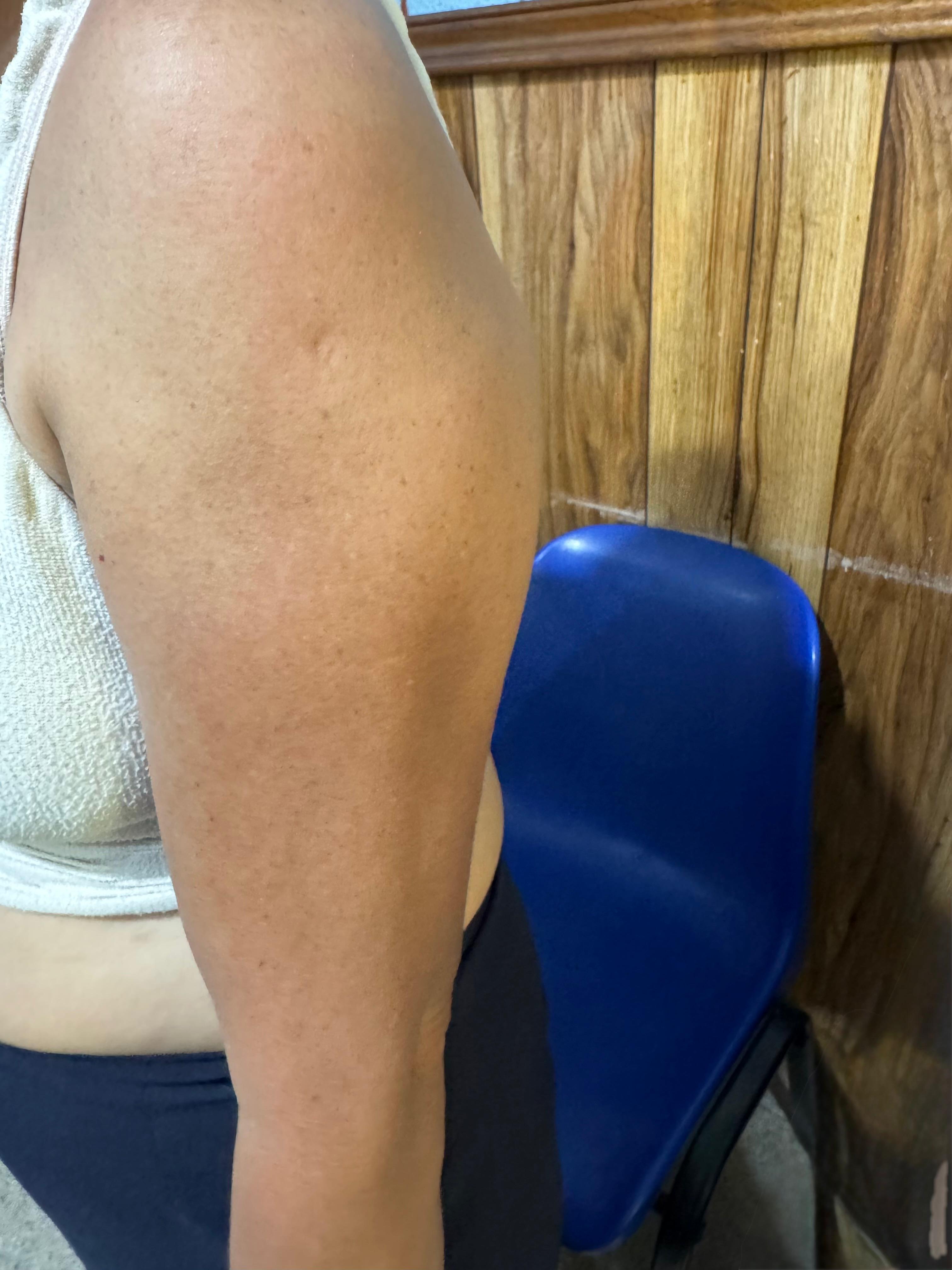 DERMATOSIS CENICIENTA