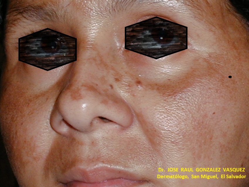 MELASMA