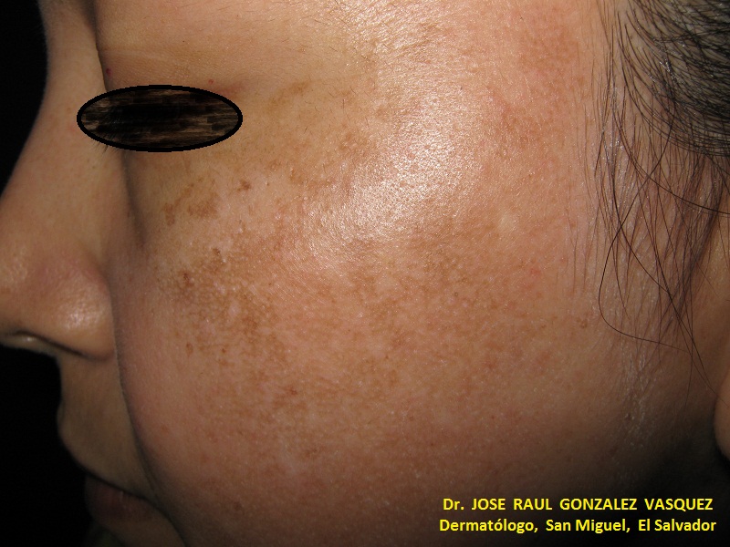 MELASMA