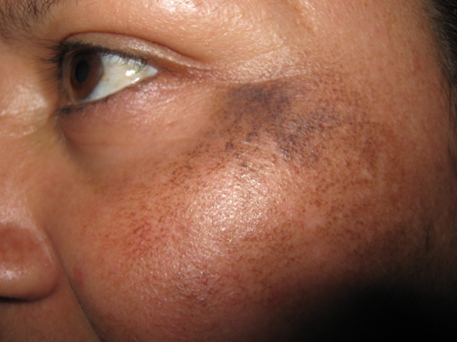 OCRONOSIS - HIDROQUINONA