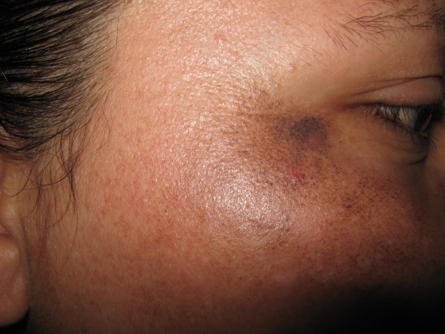 OCRONOSIS - HIDROQUINONA