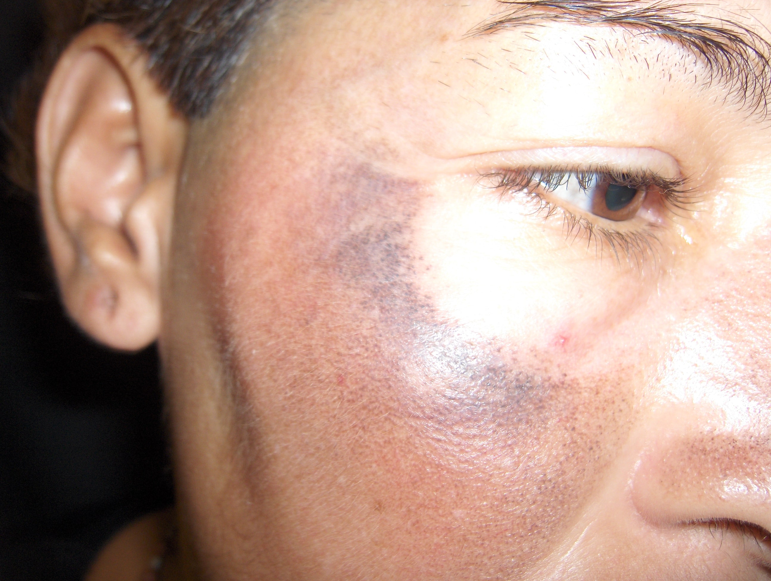 OCRONOSIS - HIDROQUINONA