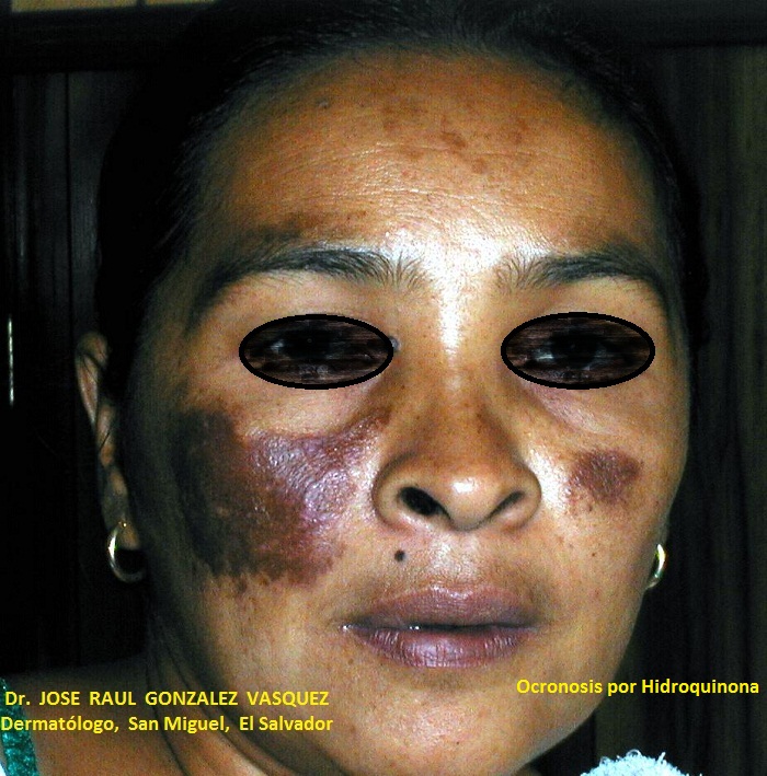 OCRONOSIS - HIDROQUINONA