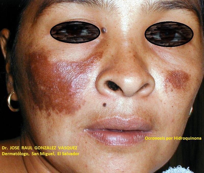 OCRONOSIS - HIDROQUINONA