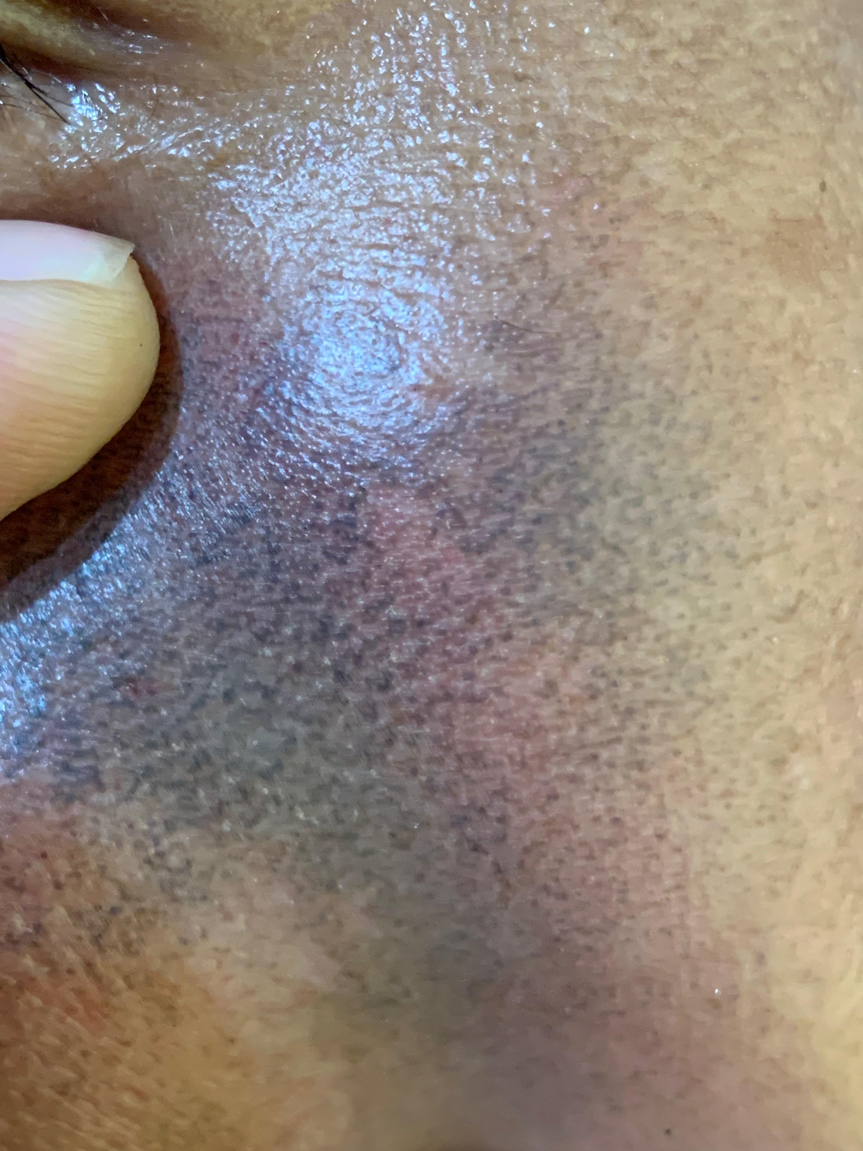 OCRONOSIS - HIDROQUINONA