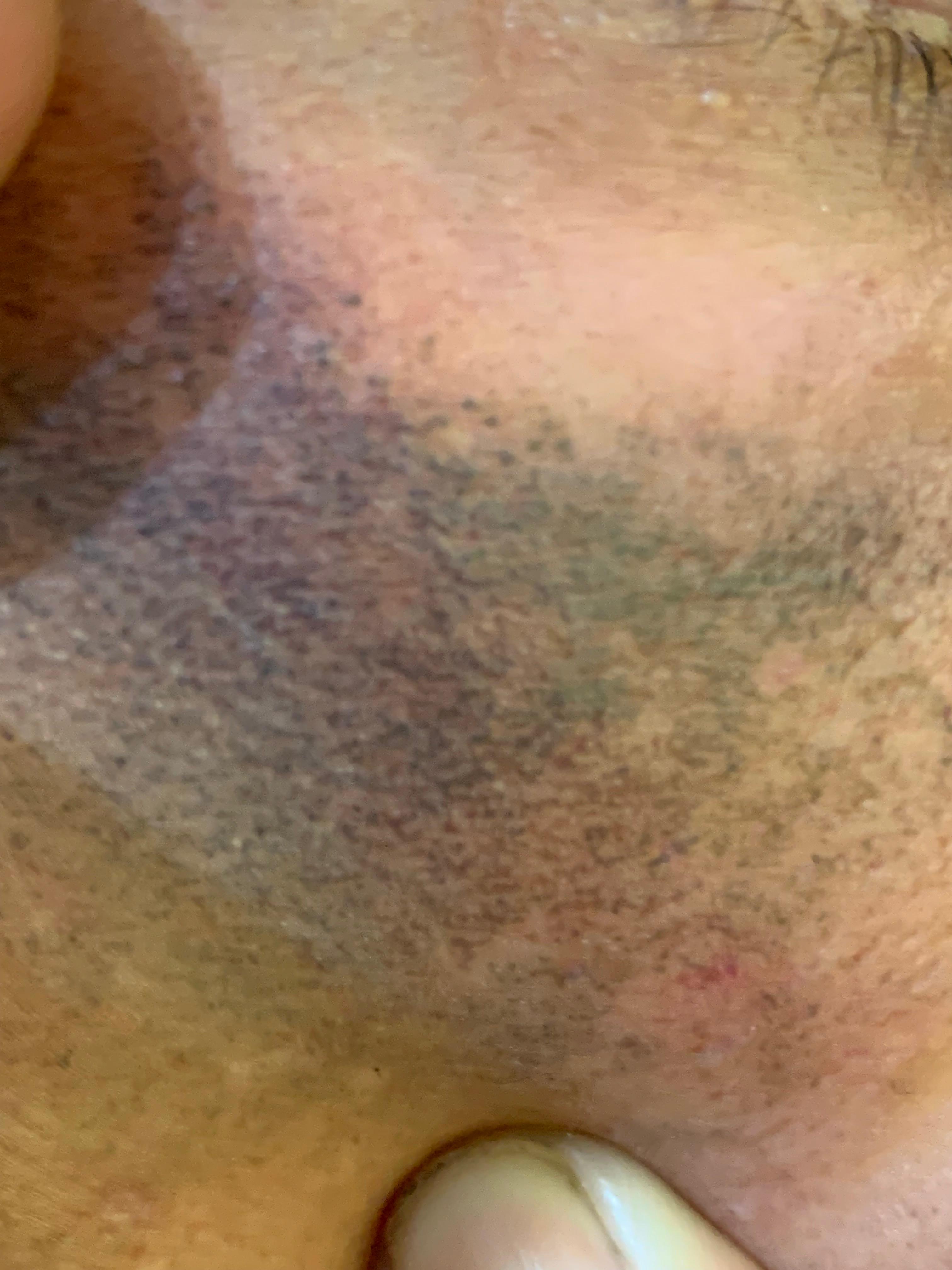 OCRONOSIS - HIDROQUINONA